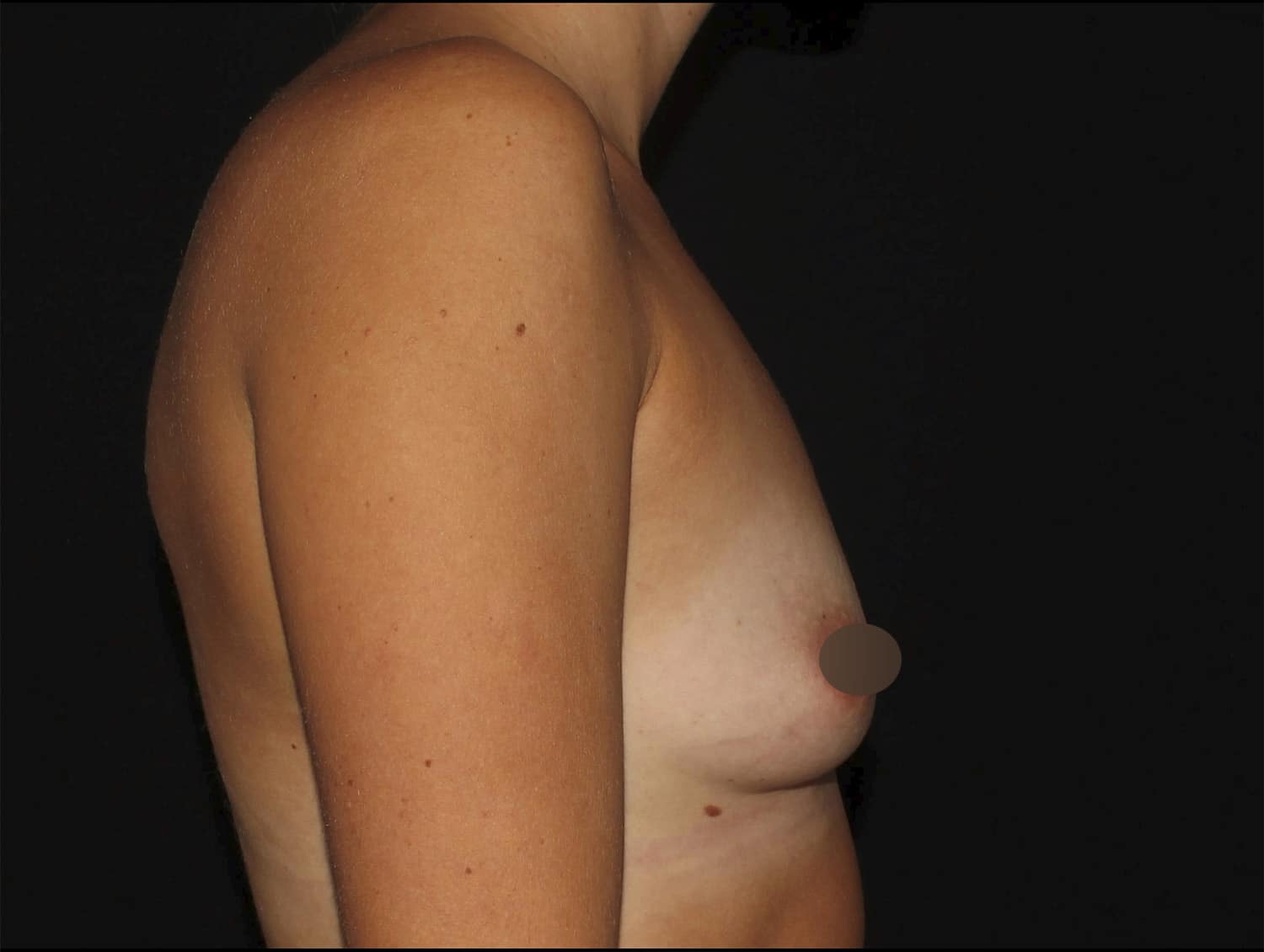 Before Image: Breast Augmentation - right-side