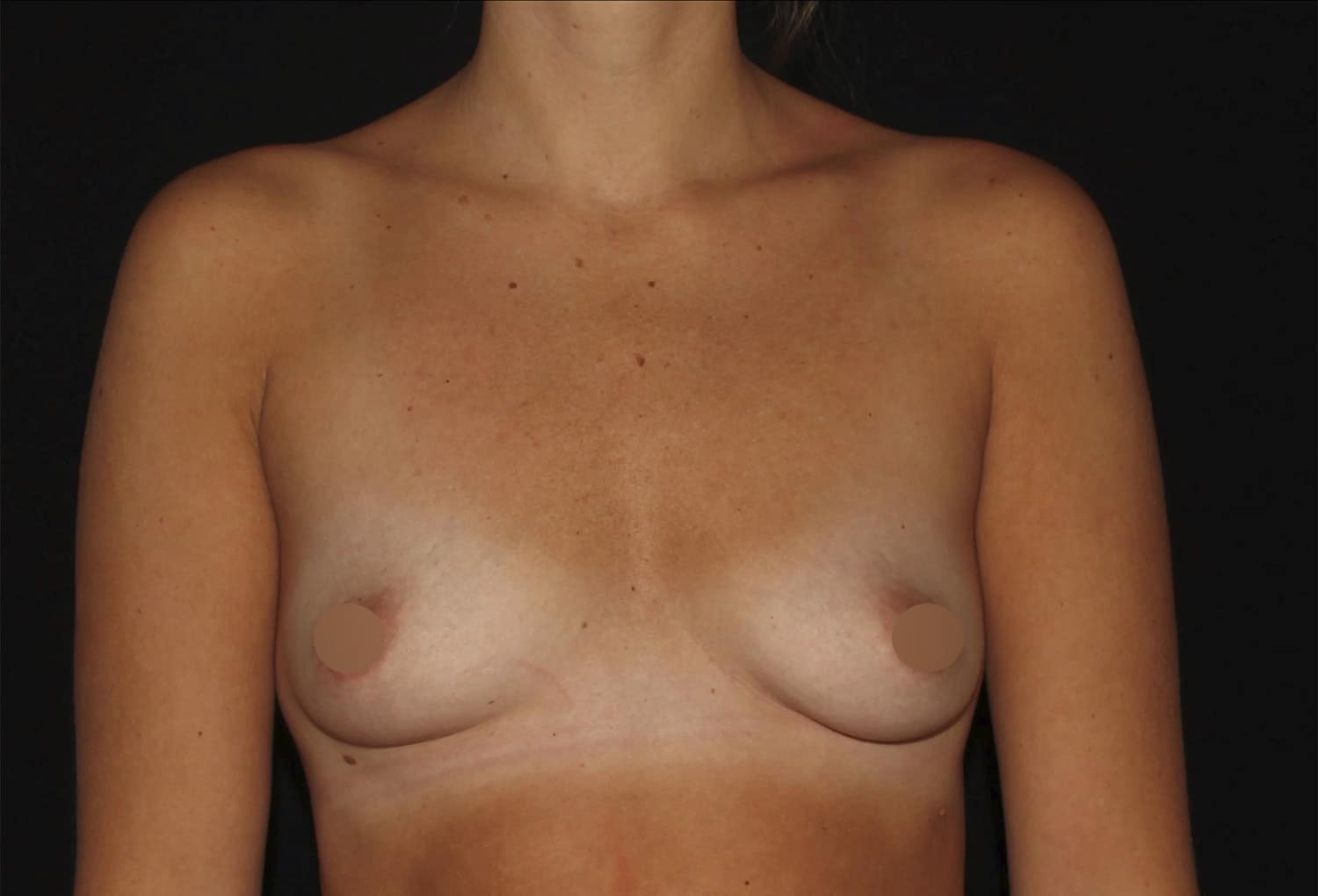 Before Image: Breast Augmentation - front