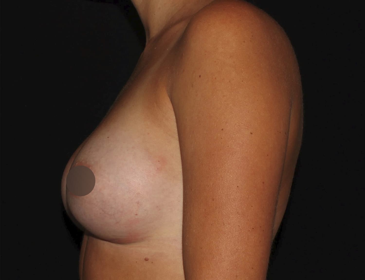 After Image: Breast Augmentation - left-side