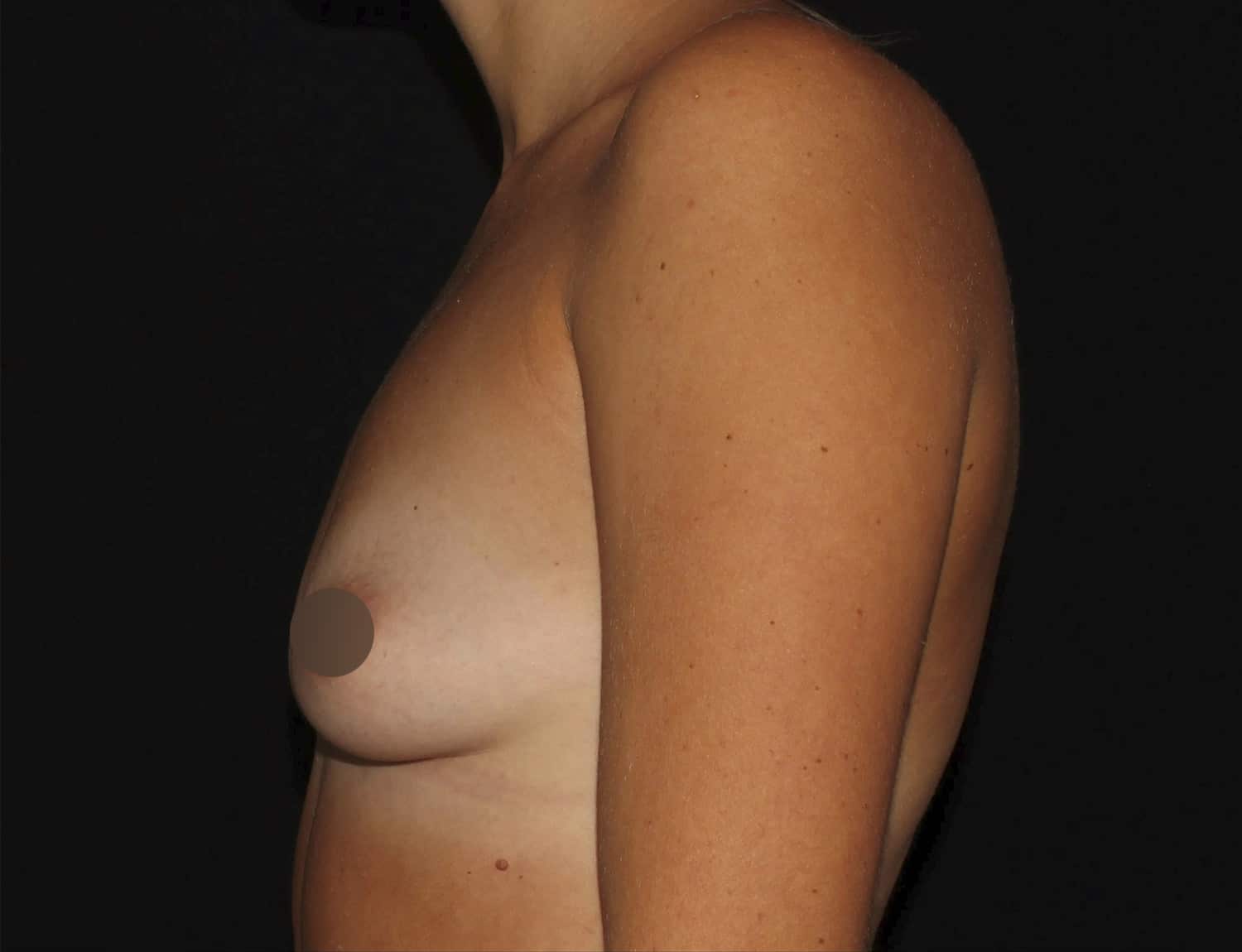 Before Image: Breast Augmentation - left-side