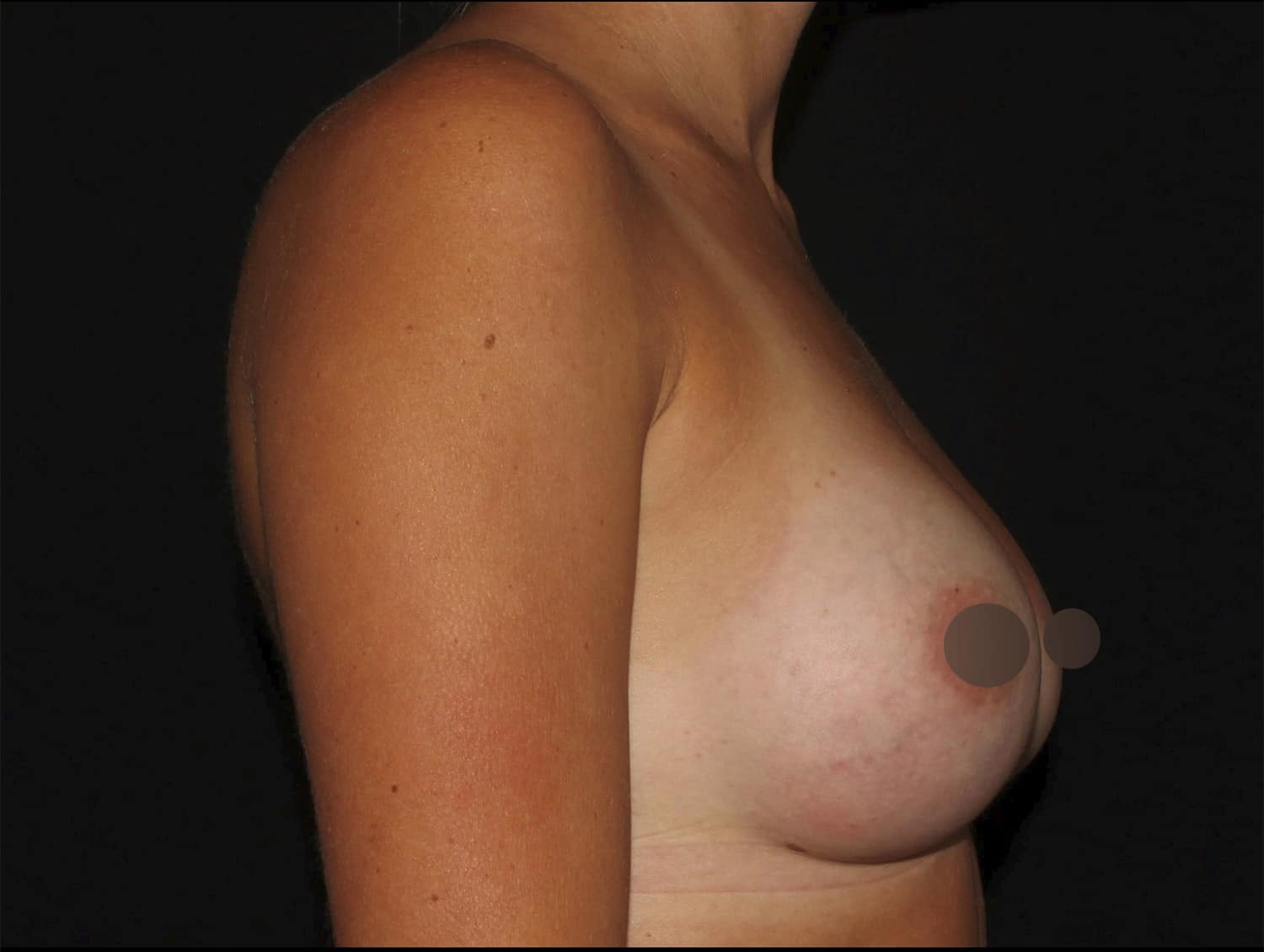 After Image: Breast Augmentation - right-side