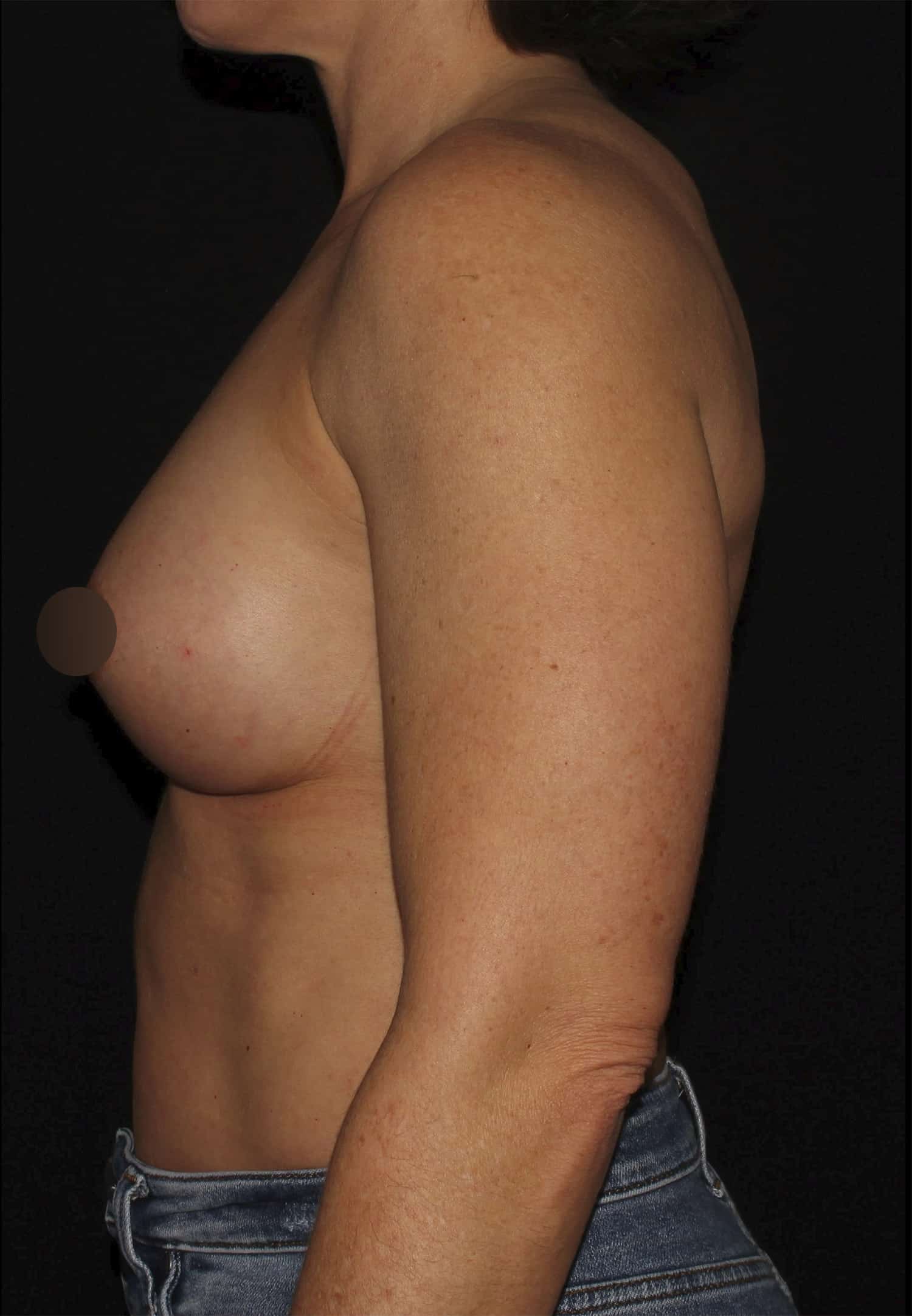 After Image: Breast Augmentation - left-side