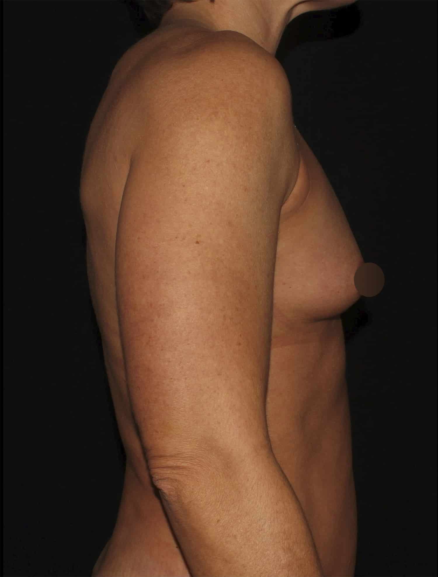 Before Image: Breast Augmentation - right-side