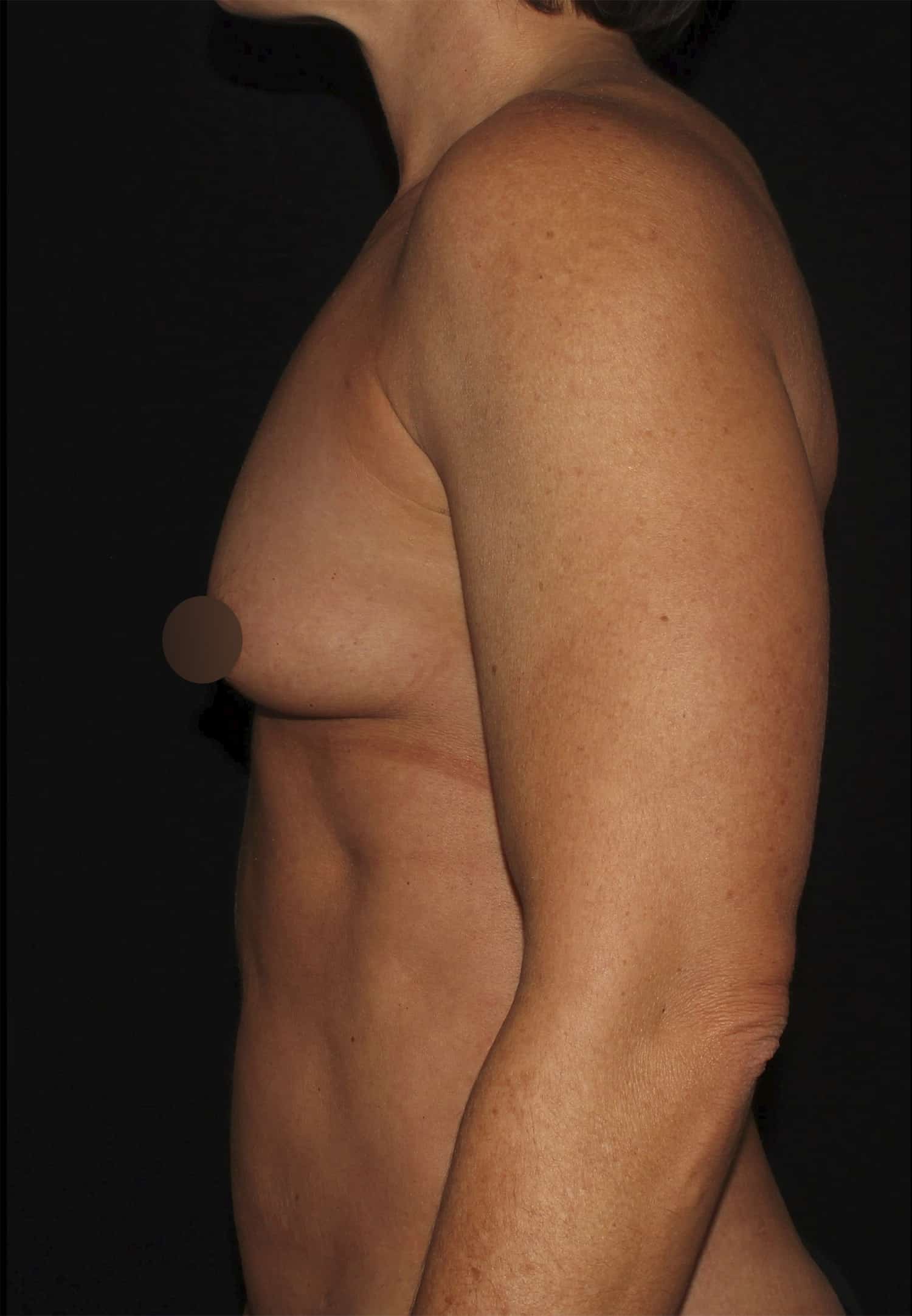 Before Image: Breast Augmentation - left-side