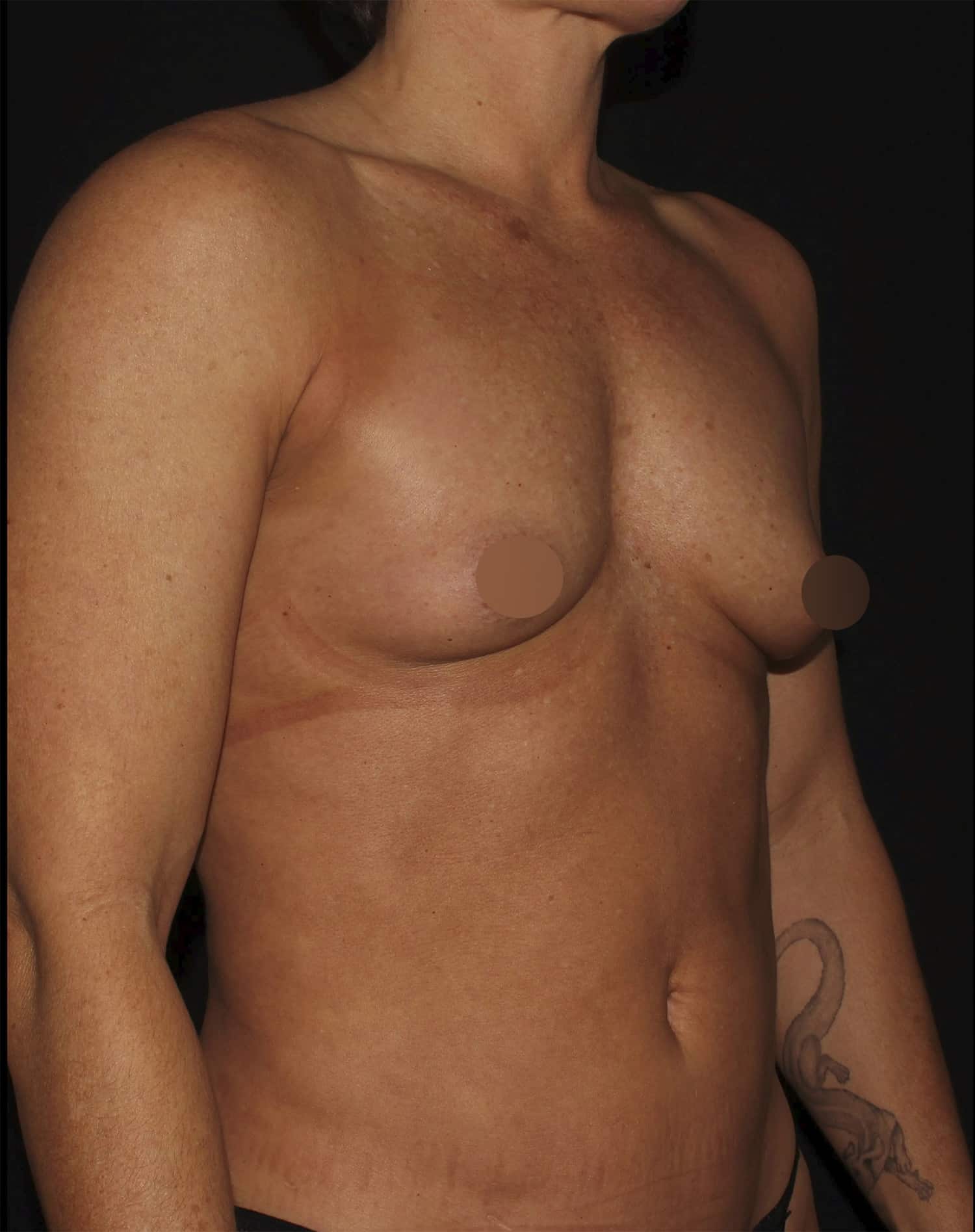 Before Image: Breast Augmentation - right-front-oblique