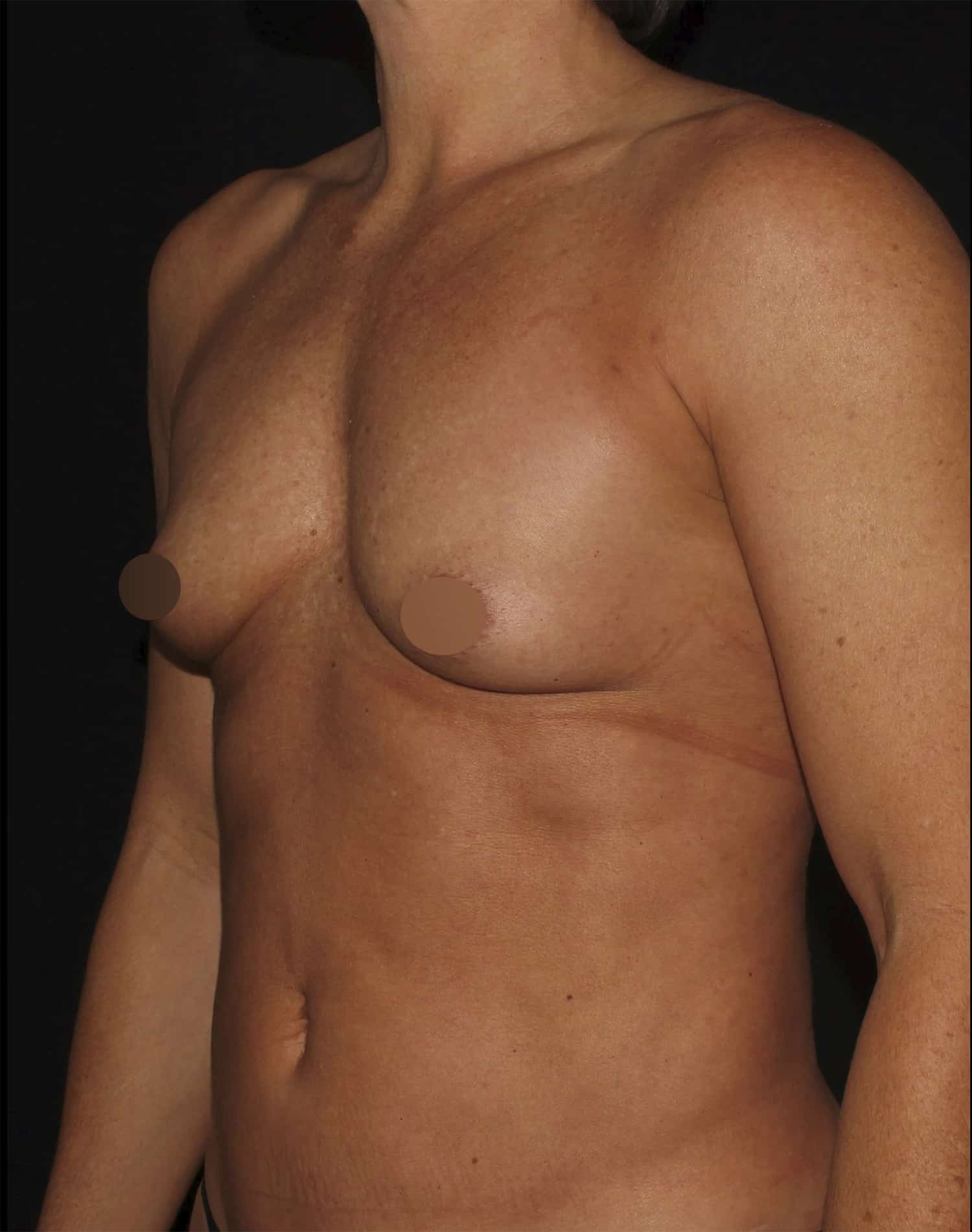 Before Image: Breast Augmentation - left-front-oblique