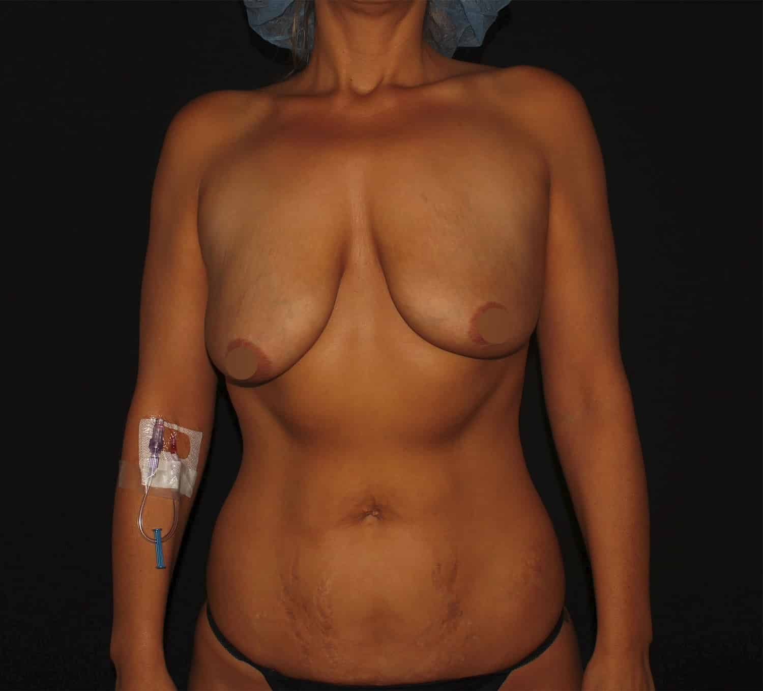 Before Image: Breast Augmentation - 