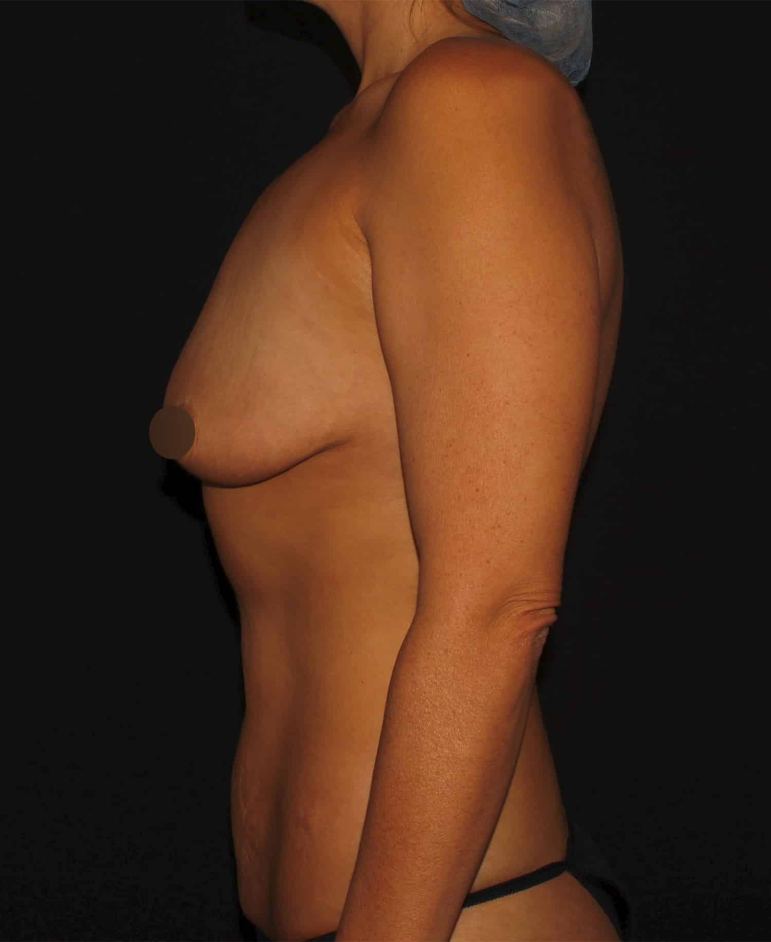 Before Image: Breast Augmentation - 