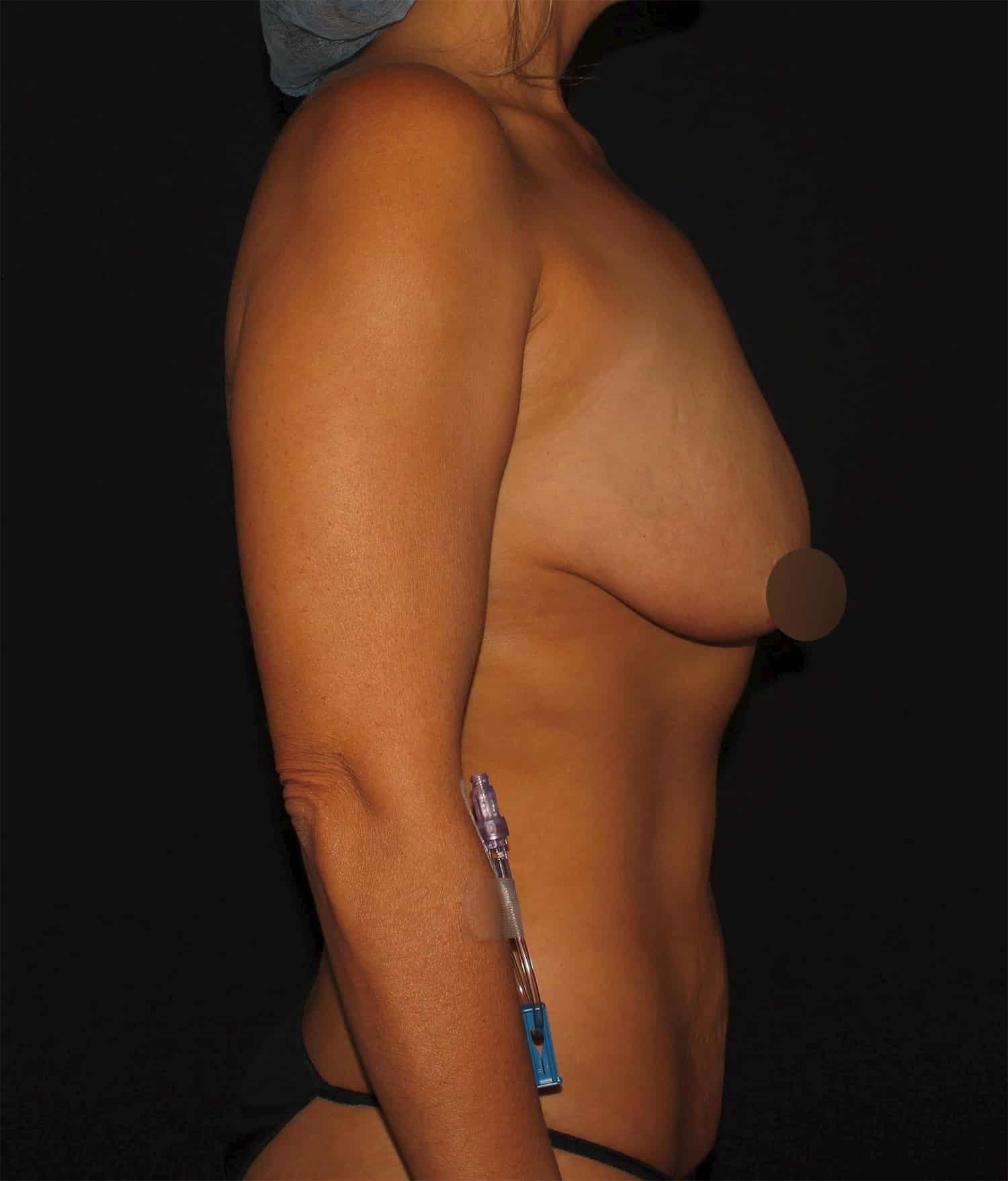 Before Image: Breast Augmentation - right-side