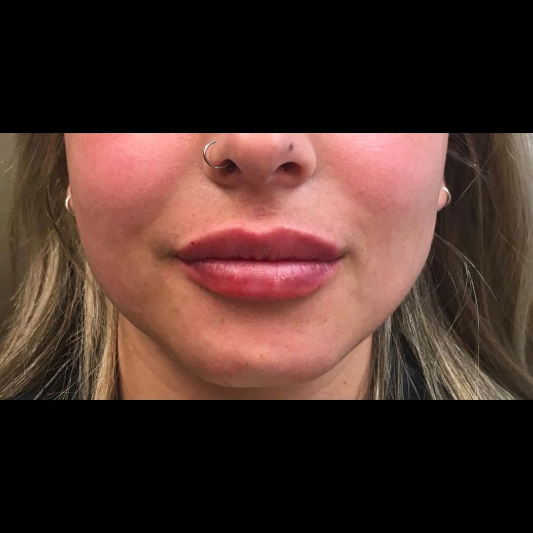 After Image: Lip Filler - front