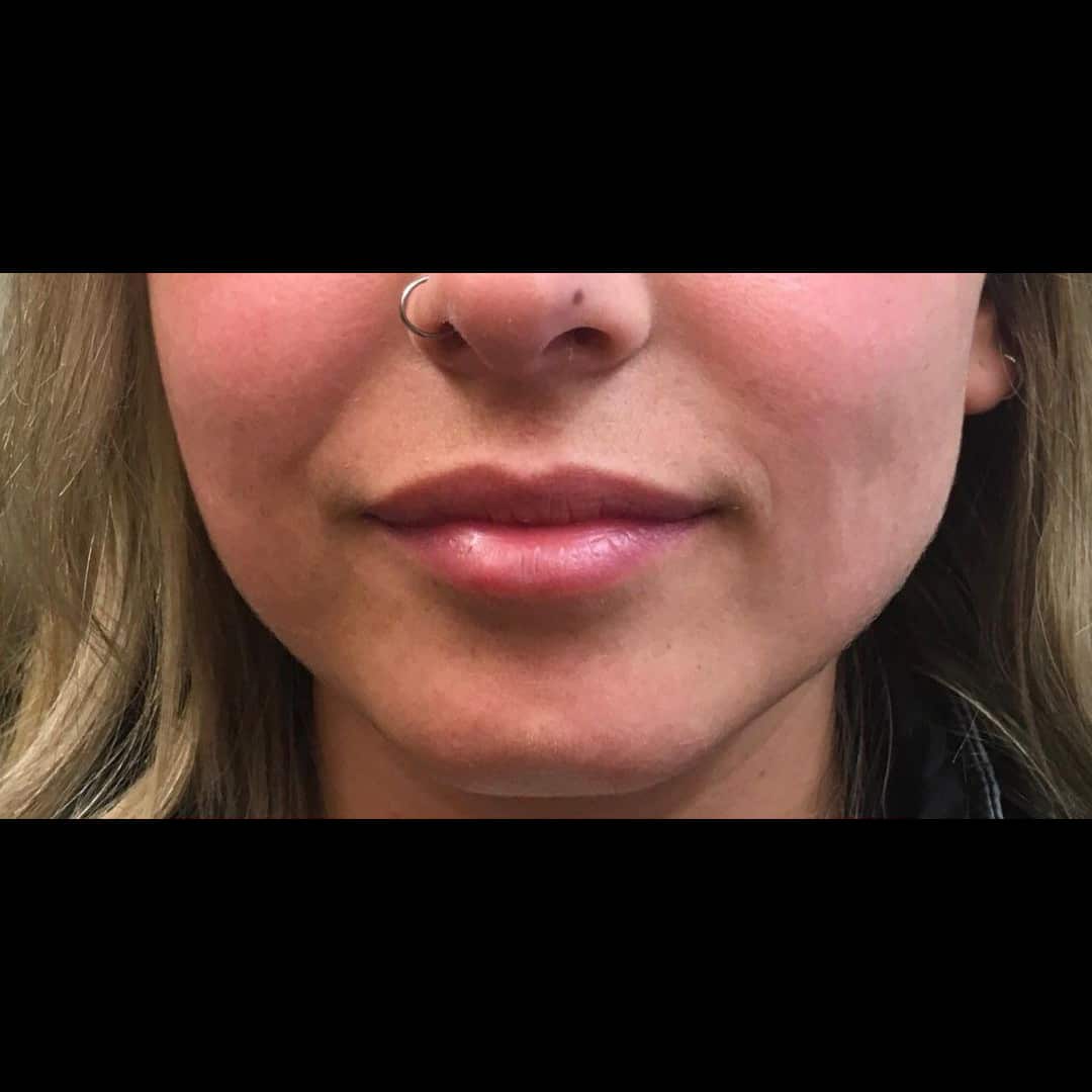 Before Image: Lip Filler - front