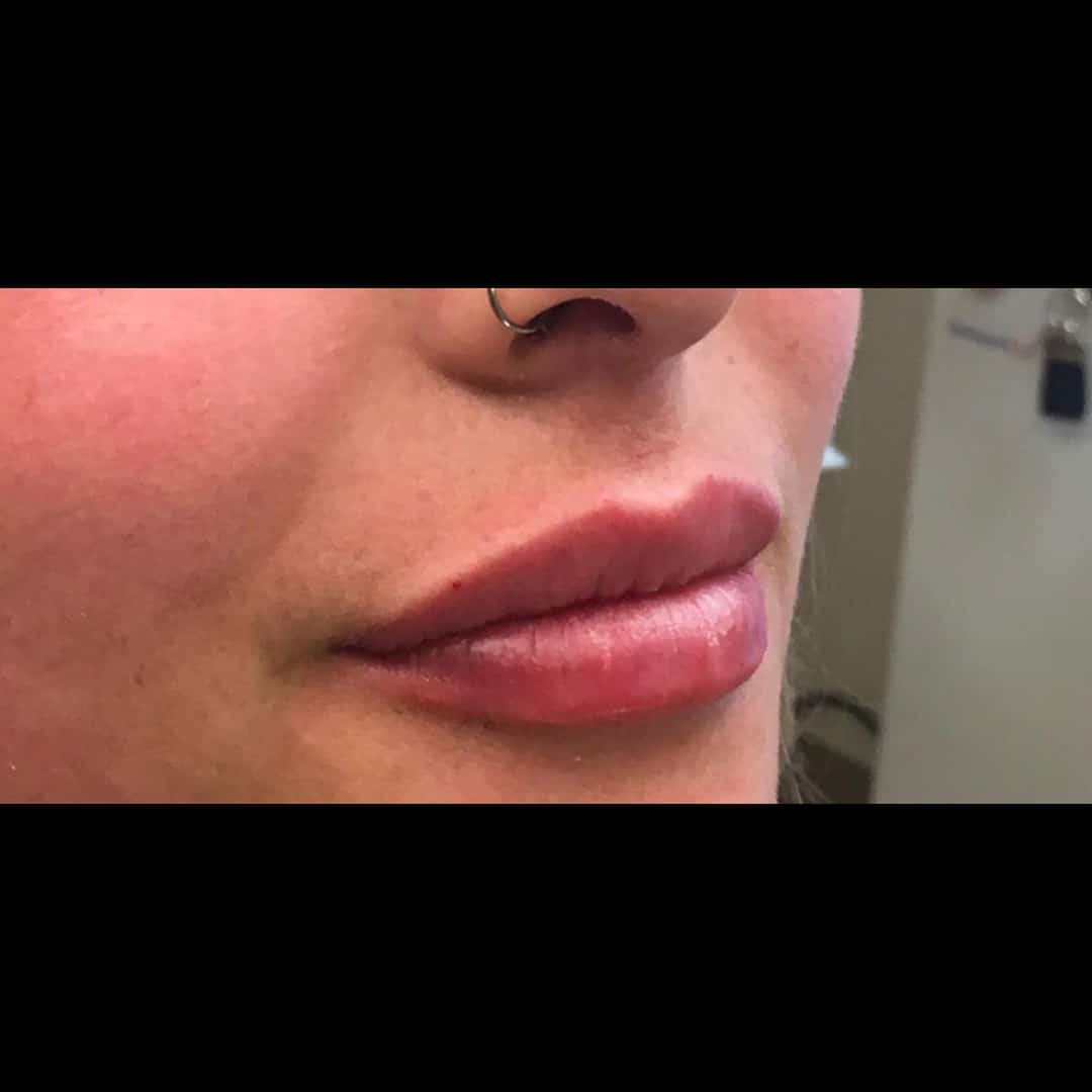 After Image: Lip Filler - right-front-oblique