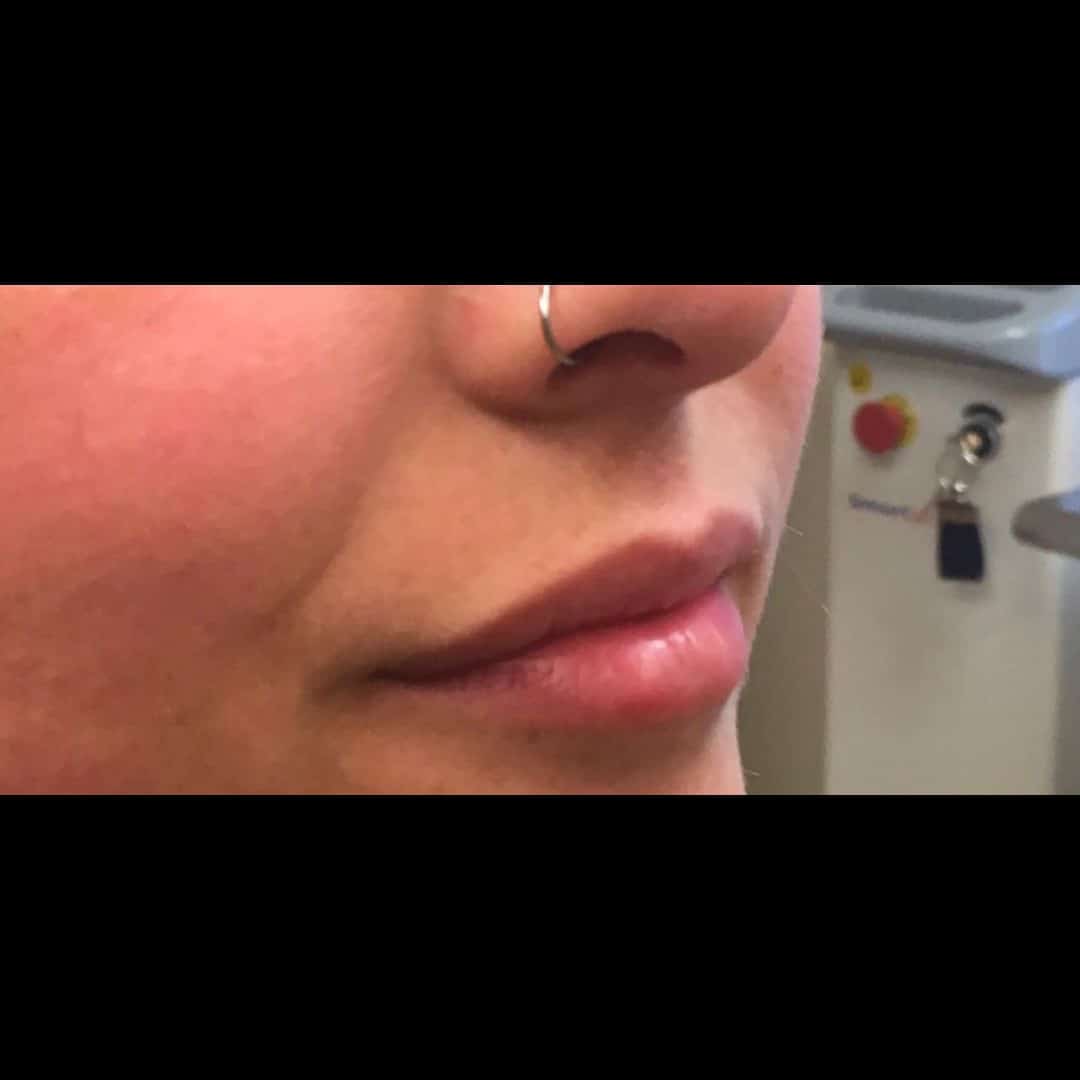 Before Image: Lip Filler - right-front-oblique