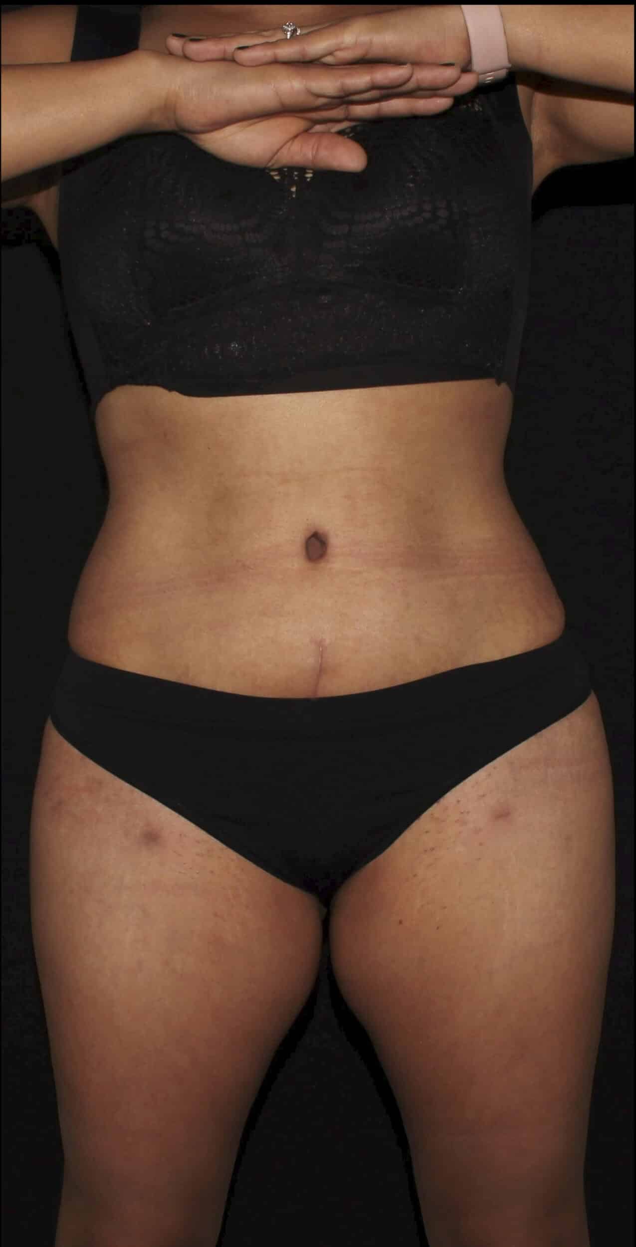 After Image: Lipo 360, BBL, & Tummy Tuck