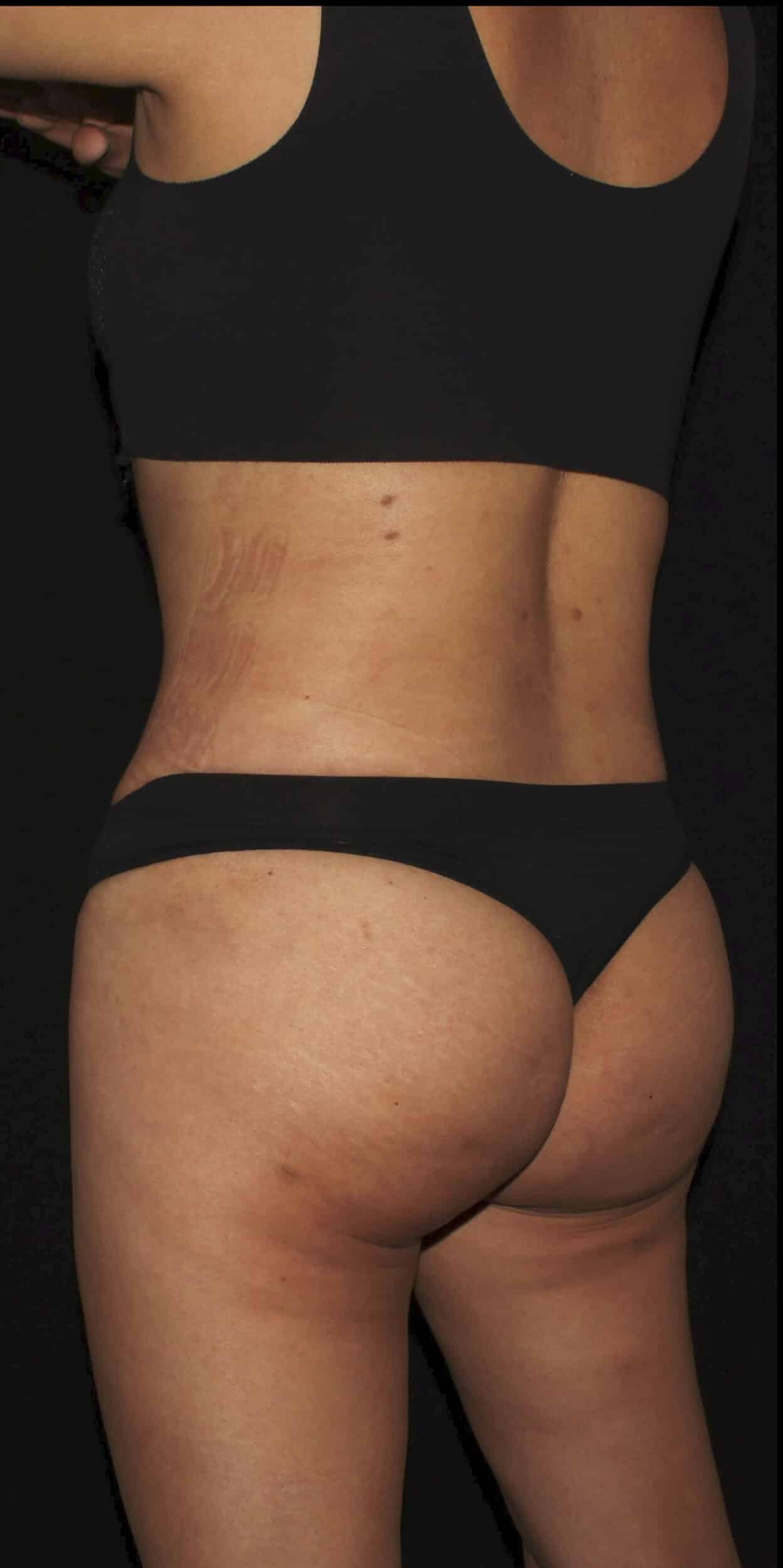 After Image: Lipo 360, BBL, & Tummy Tuck - left-back-oblique