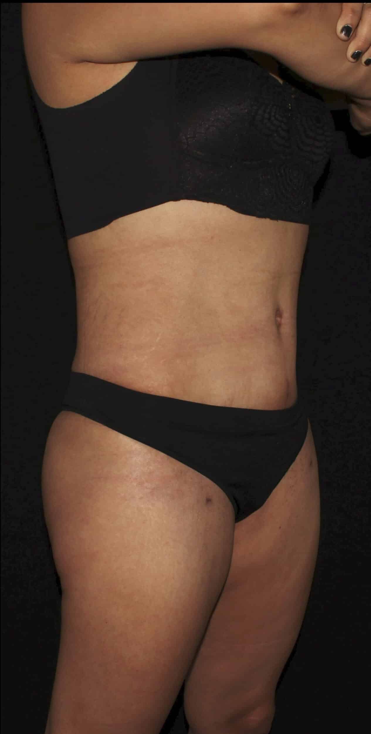 After Image: Lipo 360, BBL, & Tummy Tuck - right-front-oblique