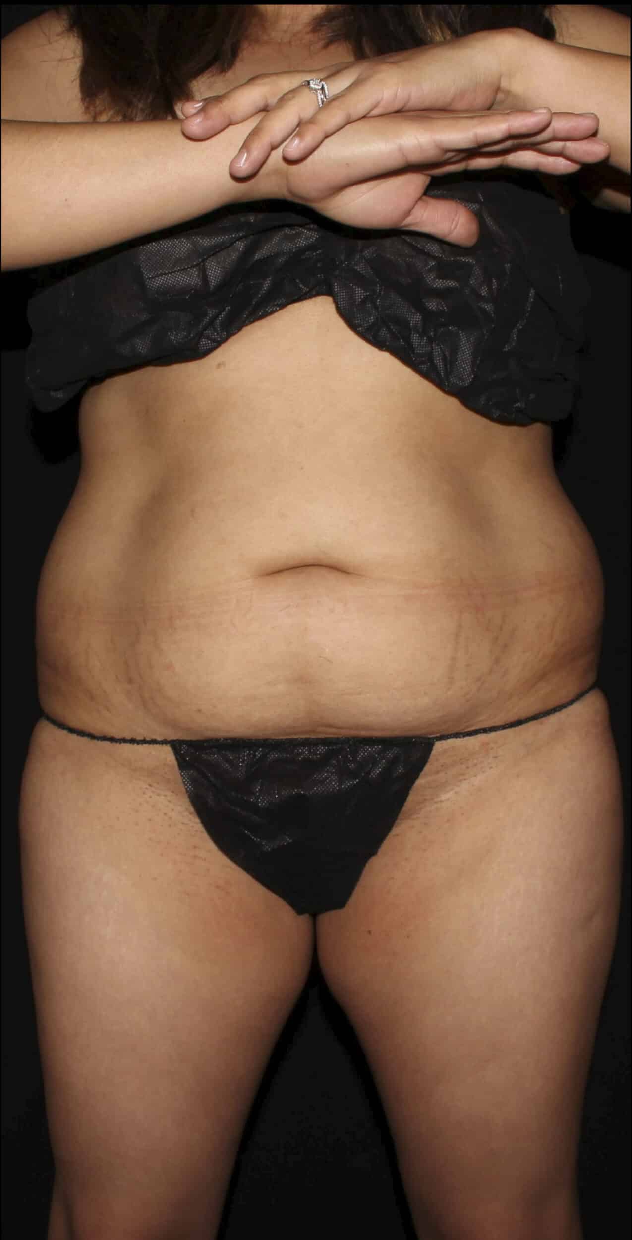 Before Image: Lipo 360, BBL, & Tummy Tuck