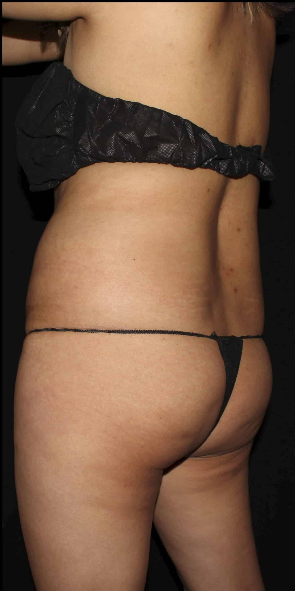 Before Image: Lipo 360, BBL, & Tummy Tuck - left-back-oblique