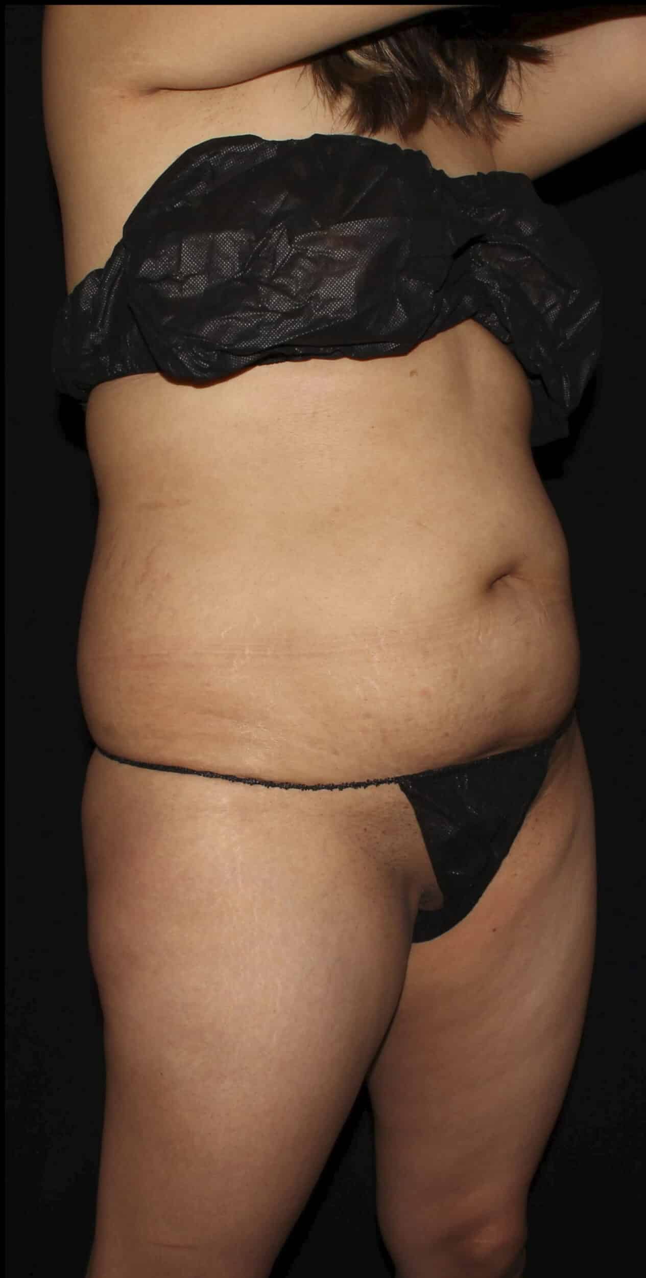 Before Image: Lipo 360, BBL, & Tummy Tuck - right-front-oblique