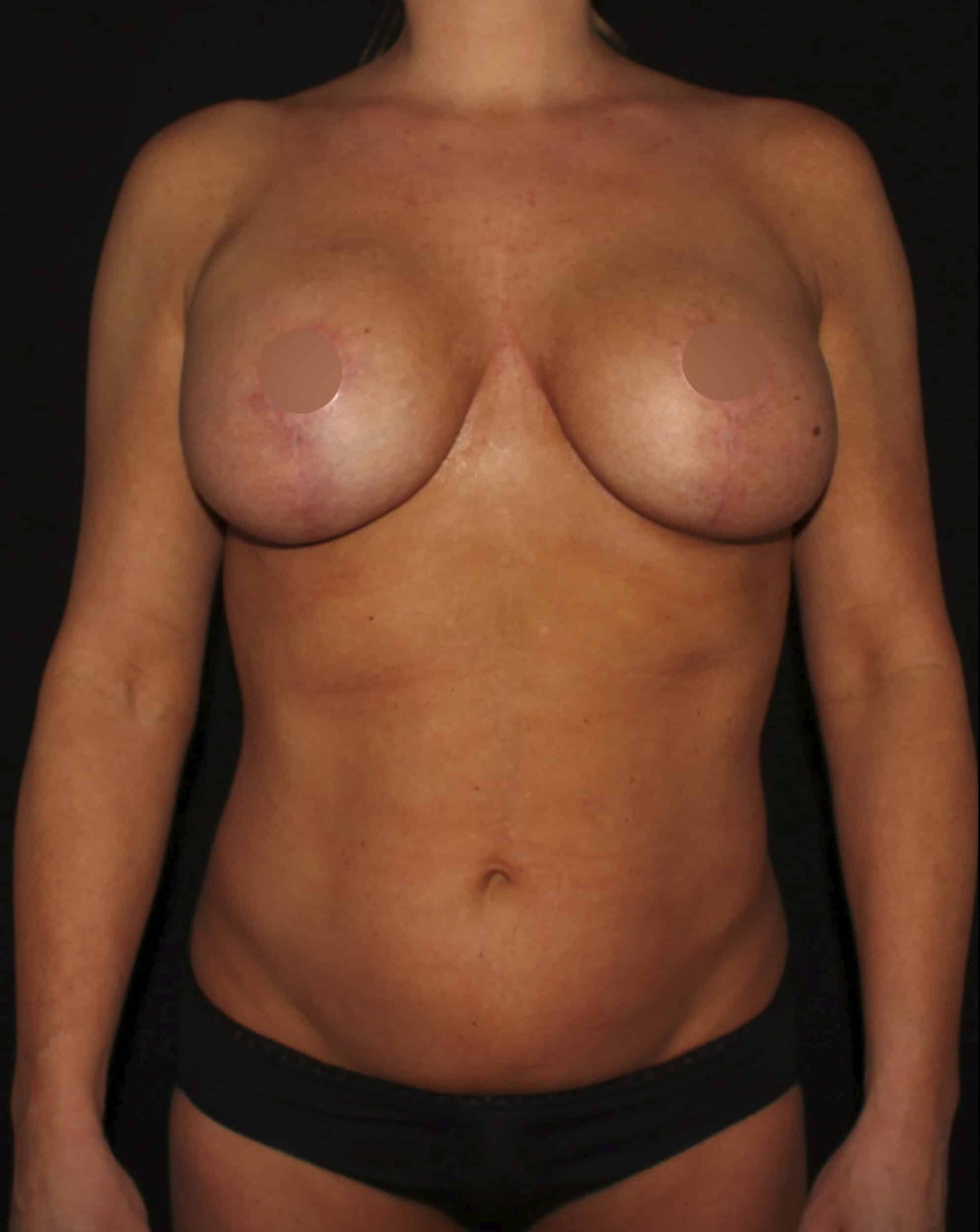 After Image: Lipo 360, BBL, & Tummy Tuck