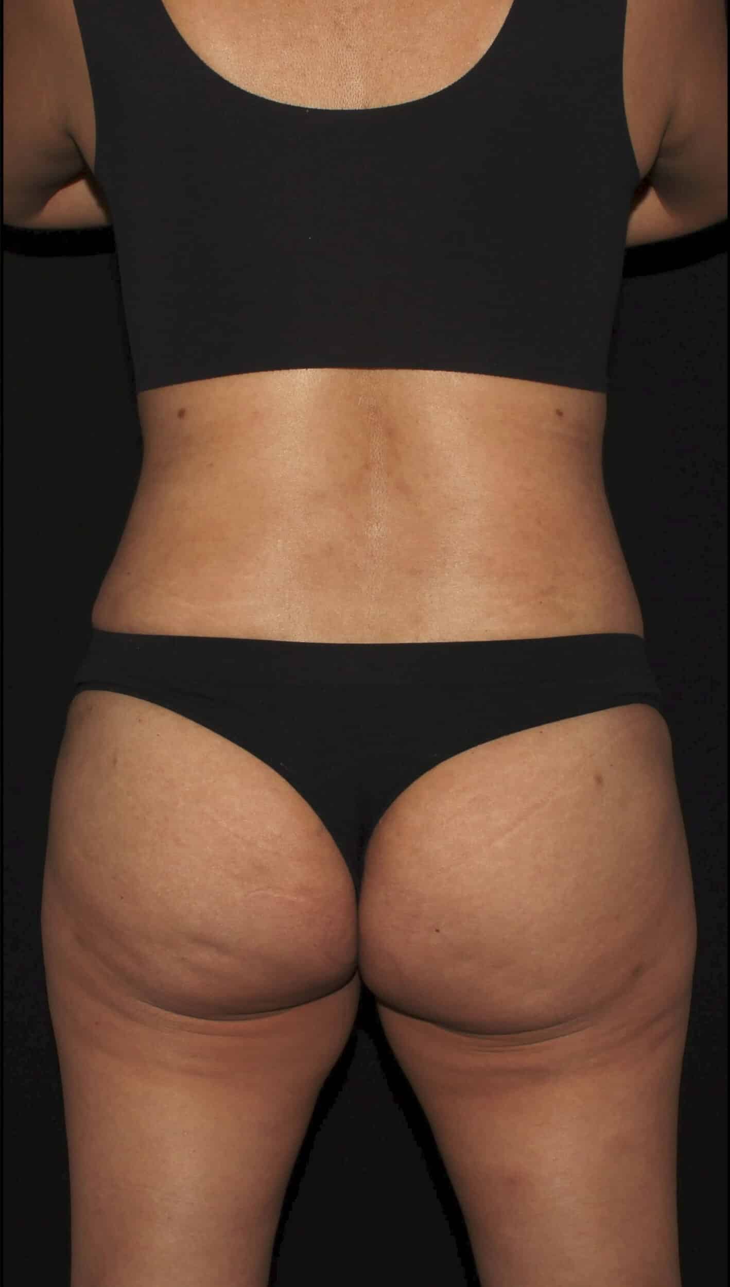 After Image: Lipo 360, BBL, & Tummy Tuck - back