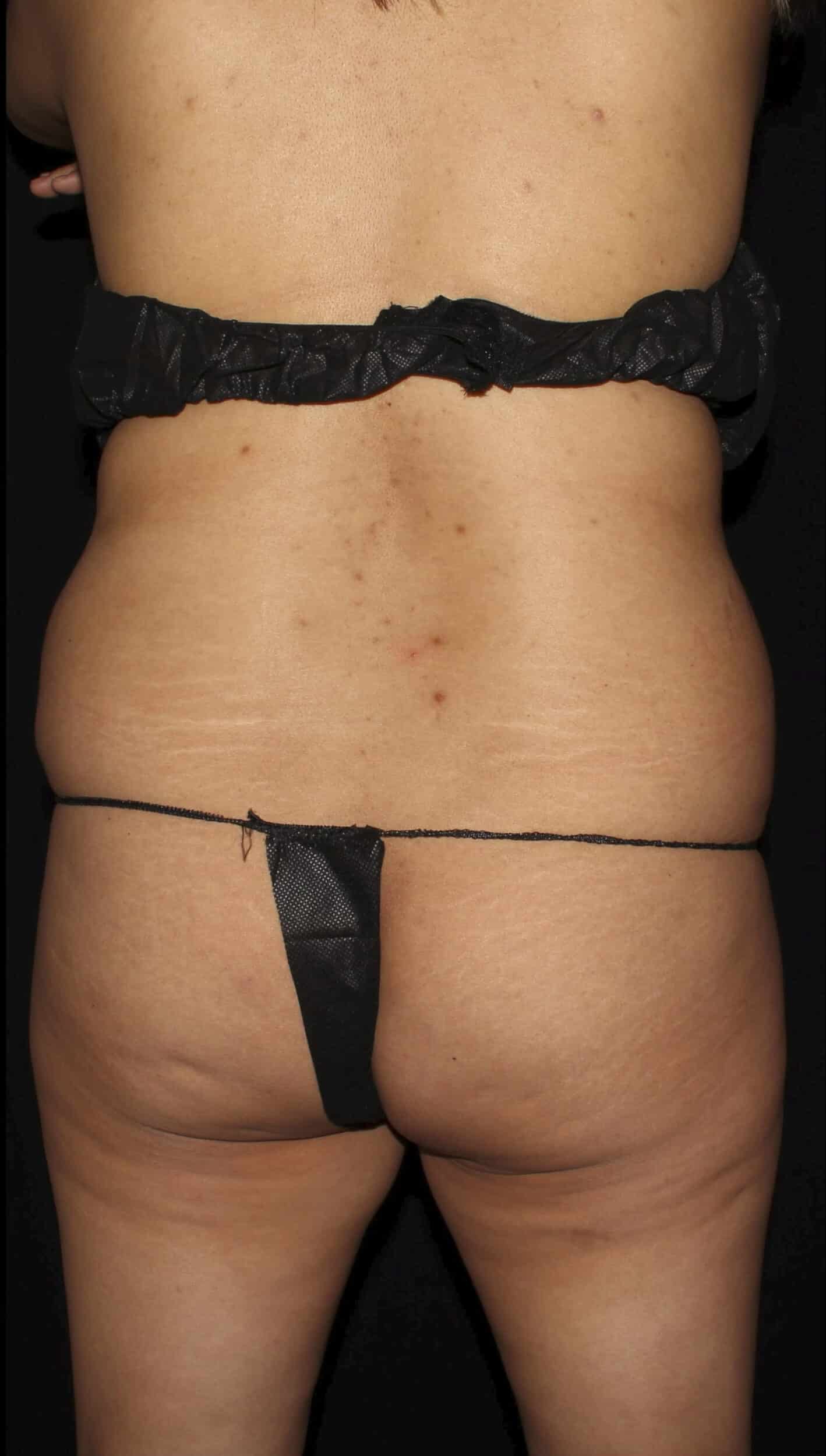 Before Image: Lipo 360, BBL, & Tummy Tuck - back