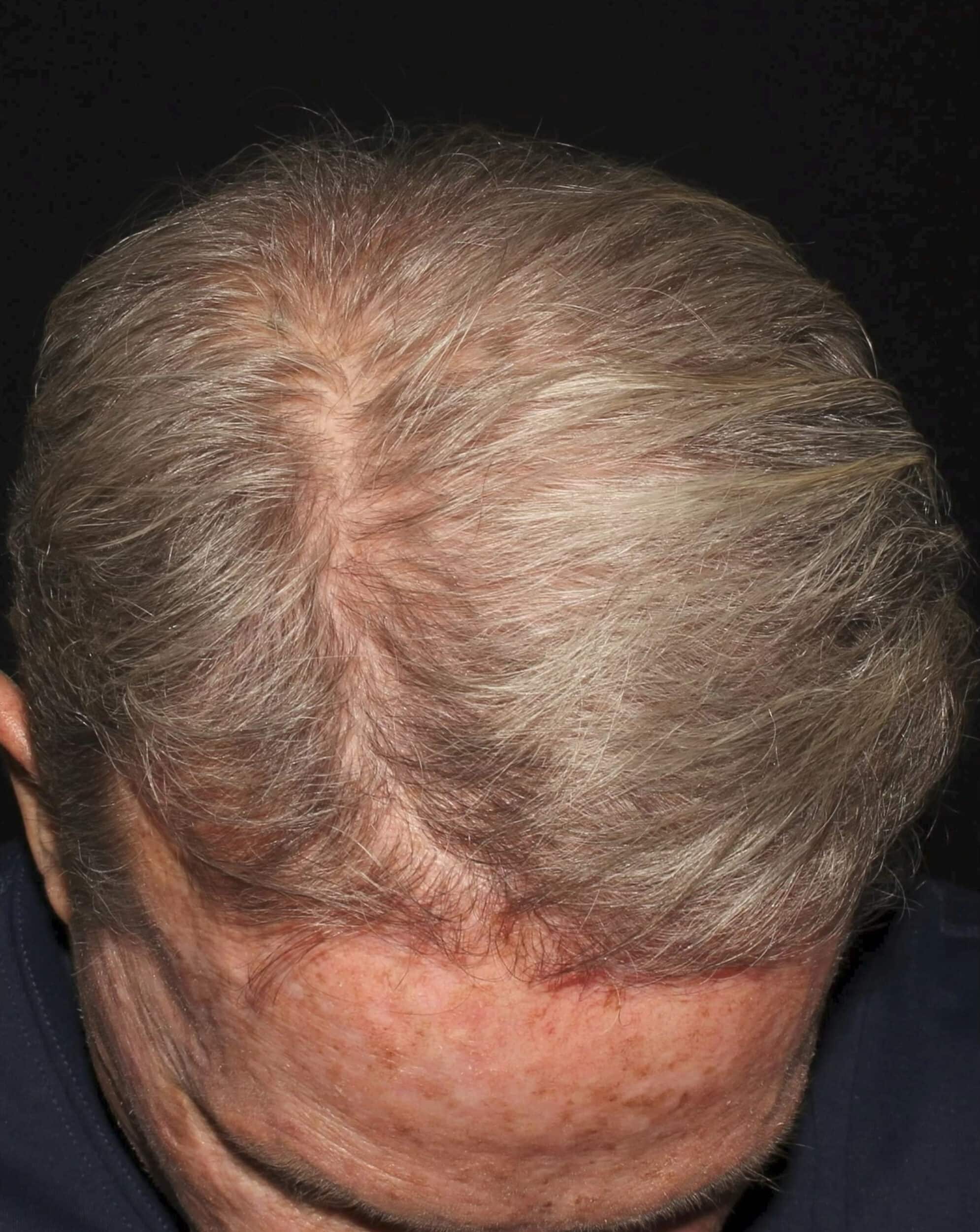 After Image: NeoGraft Hair Transplant - front