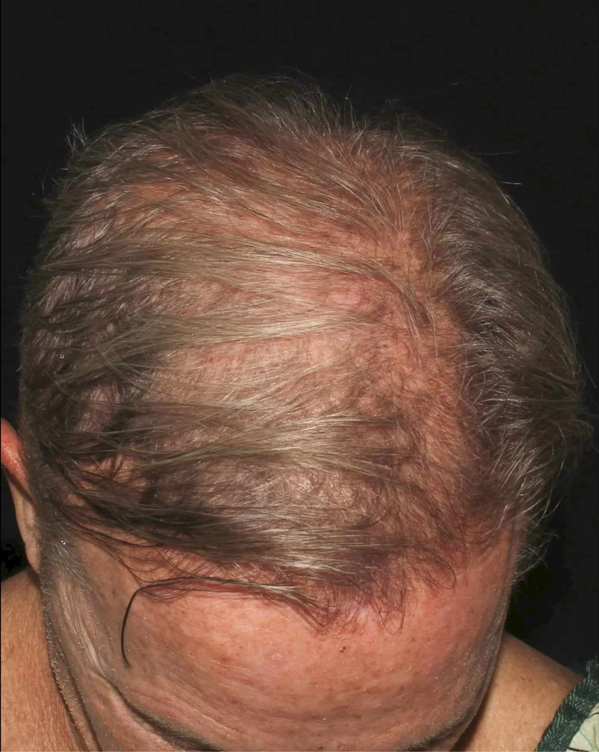 Before Image: NeoGraft Hair Transplant - front