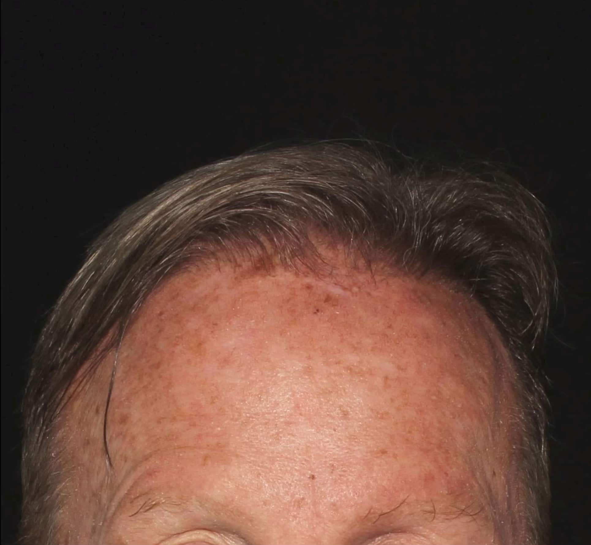 Before Image: NeoGraft Hair Transplant - front