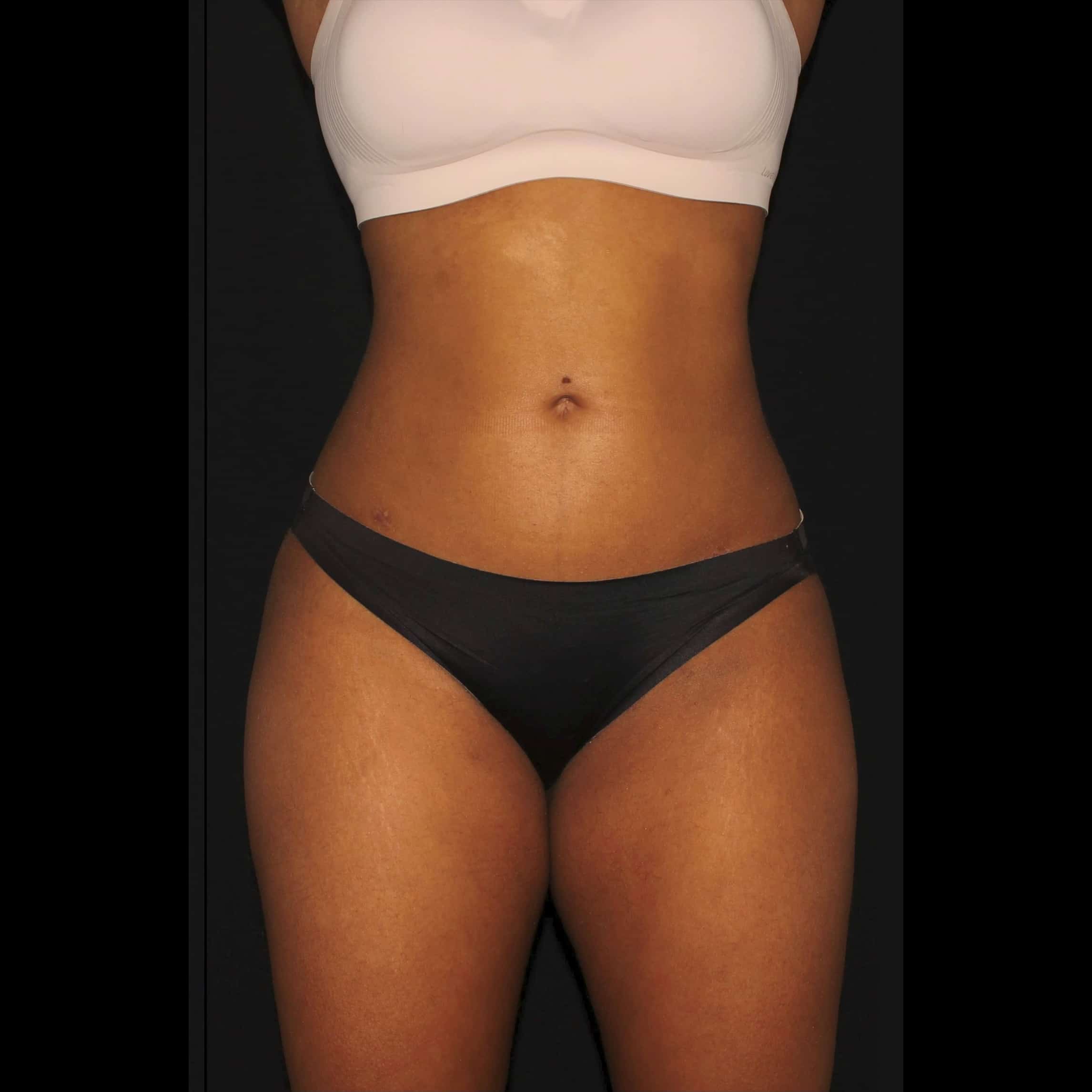 After Image: Lipo 360 & BBL