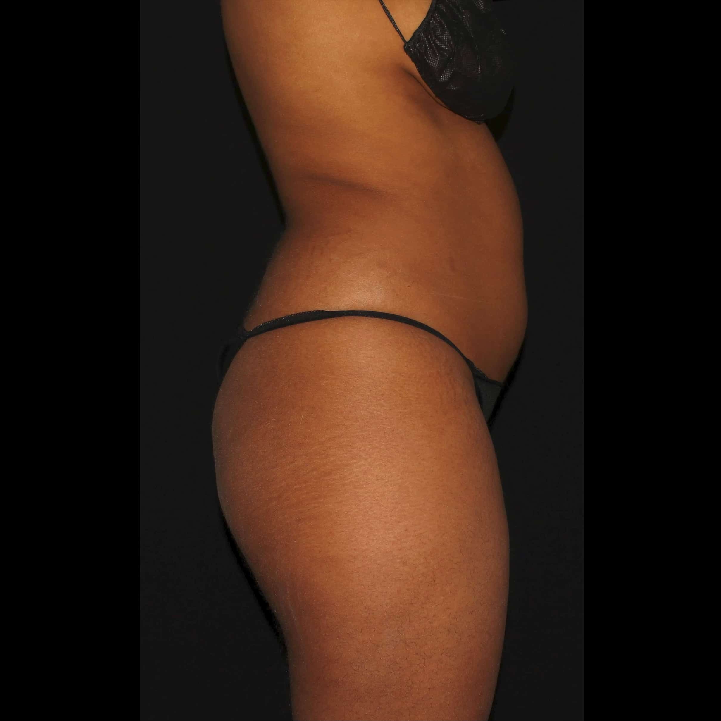 Before Image: Lipo 360 & BBL - right-side