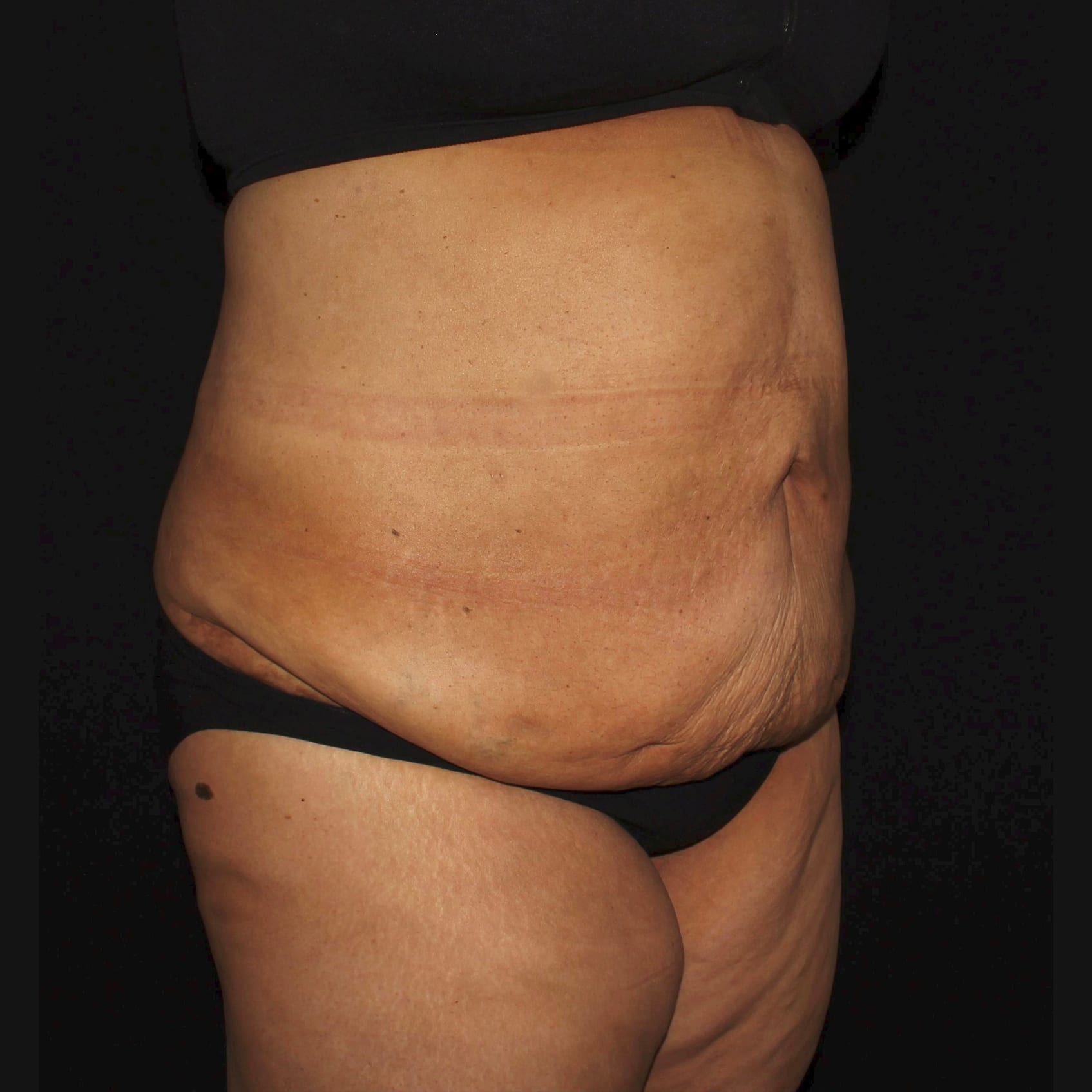 After Image: Abdomen & Waist Liposuction - right-front-oblique