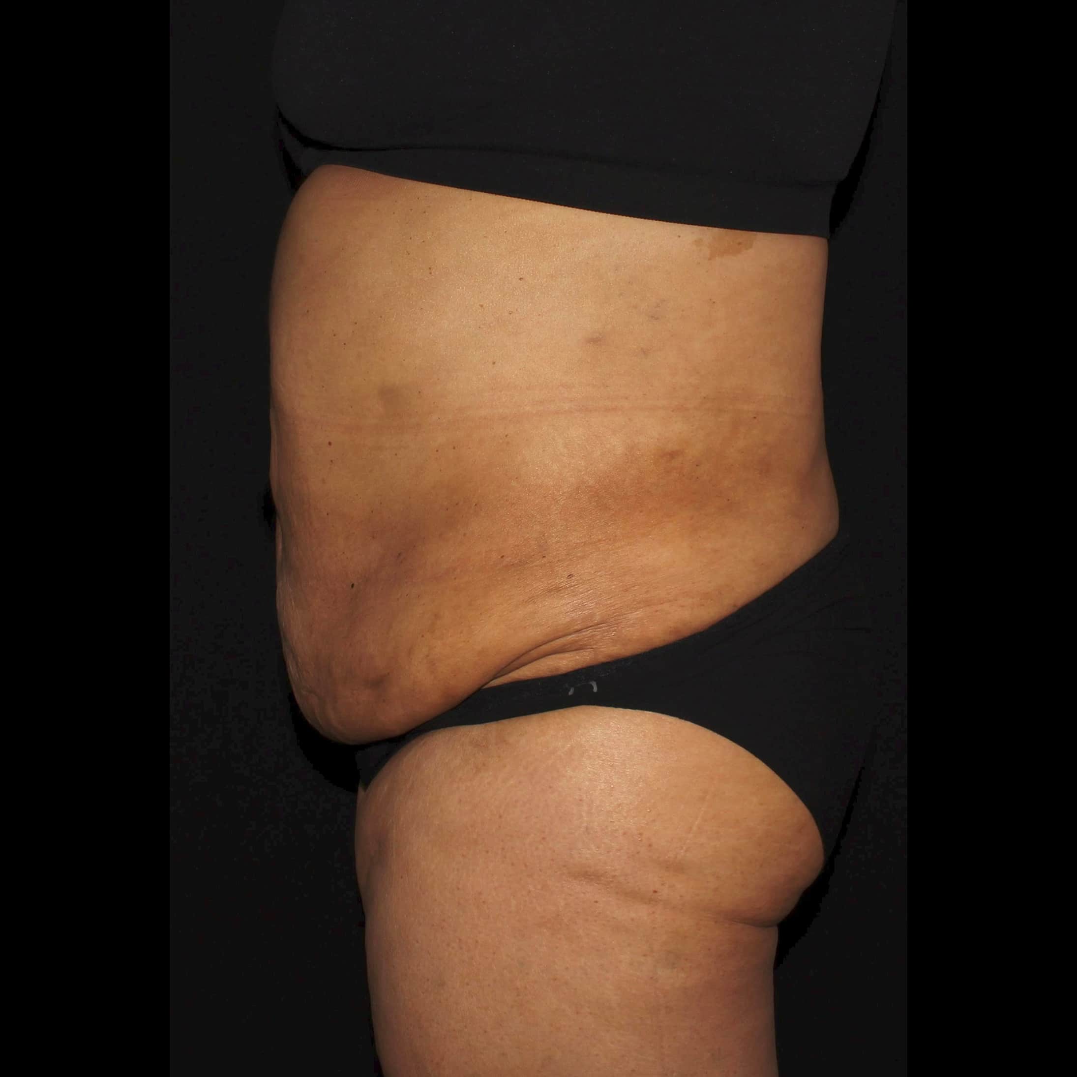 After Image: Abdomen & Waist Liposuction - left-side