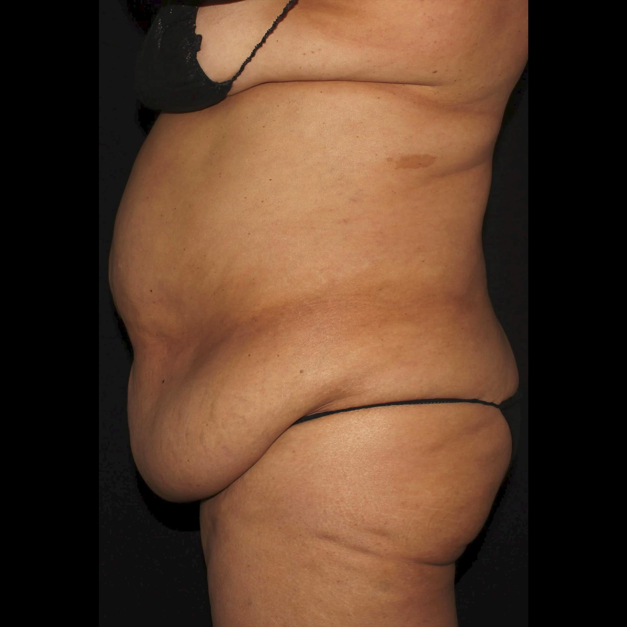 Before Image: Abdomen & Waist Liposuction - left-side