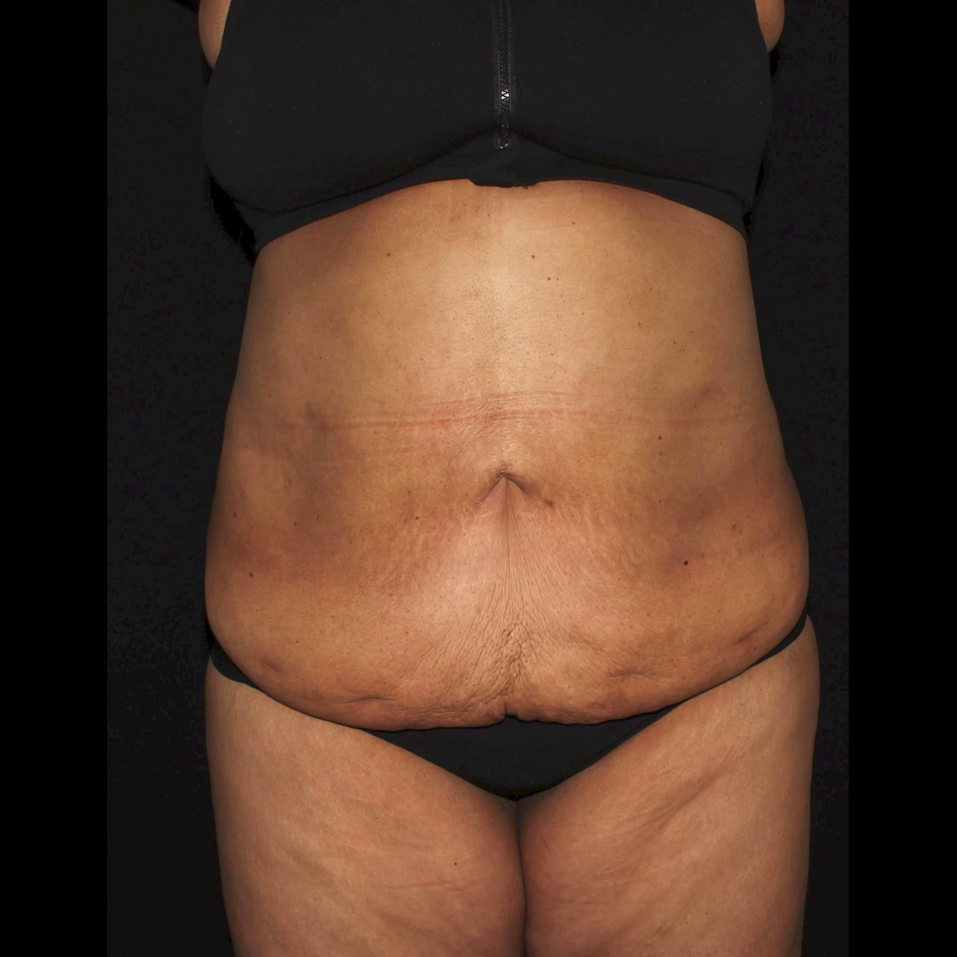 After Image: Abdomen & Waist Liposuction - front