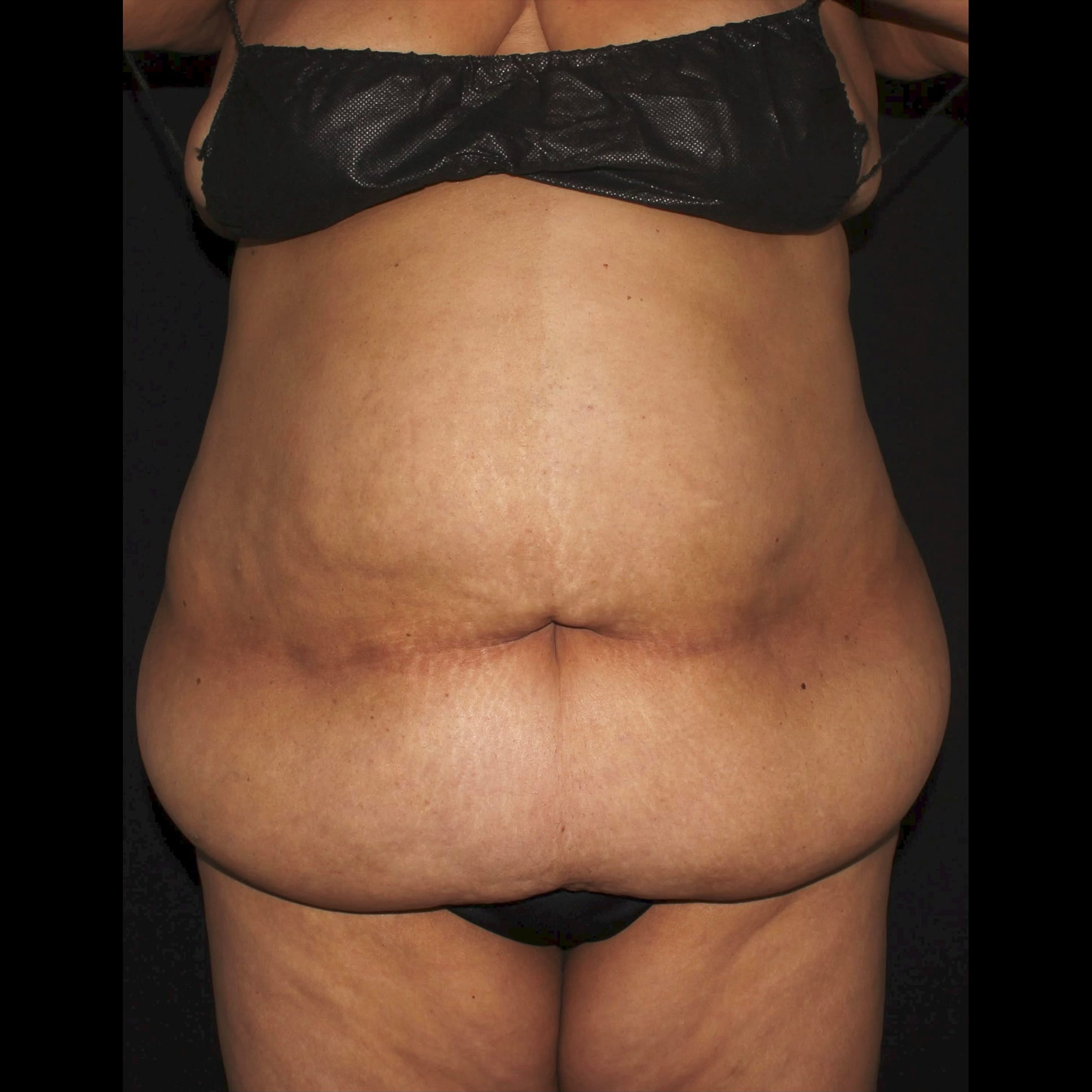 Before Image: Abdomen & Waist Liposuction - front