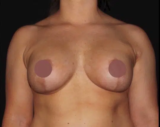 Front view after silicone gel breast augmentation demonstrating restored breast volume and improved upper pole fullness by a Boise cosmetic surgeon serving Meridian and the Treasure Valley.