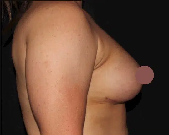 Silicone gel breast augmentation results from the left side profile highlighting enhanced breast projection and a fuller breast contour at a cosmetic surgery practice serving Boise and Meridian.