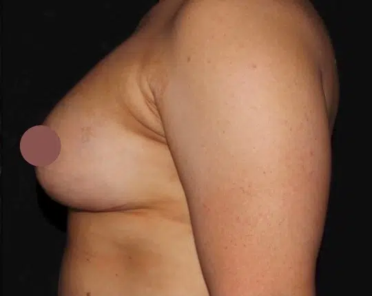 Right side profile after silicone gel breast augmentation demonstrating natural-looking breast fullness and improved breast shape by a Boise cosmetic surgeon.