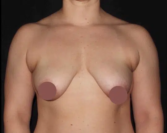 Before silicone gel breast augmentation, front view showing breast volume loss and mild breast sagging before cosmetic surgery at a Boise cosmetic surgery practice.