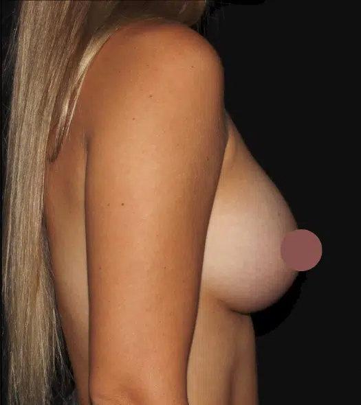 Left side profile after silicone gel breast augmentation highlighting enhanced breast projection and a fuller breast contour at a cosmetic surgery practice serving Boise and Meridian.