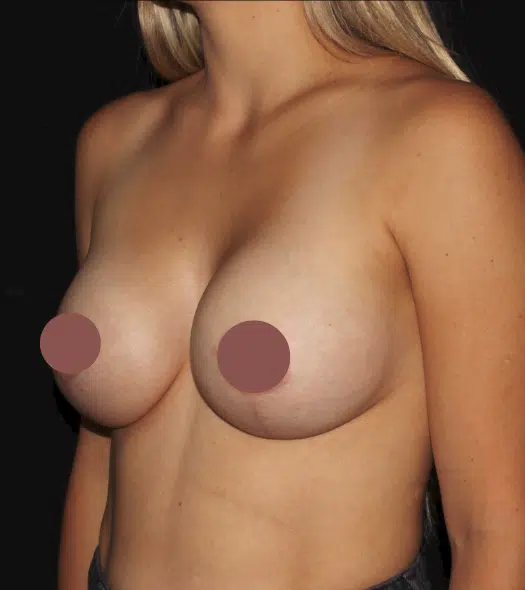 Silicone gel breast augmentation results from the left oblique view demonstrating natural-looking fullness and improved breast shape by a Boise cosmetic surgeon.