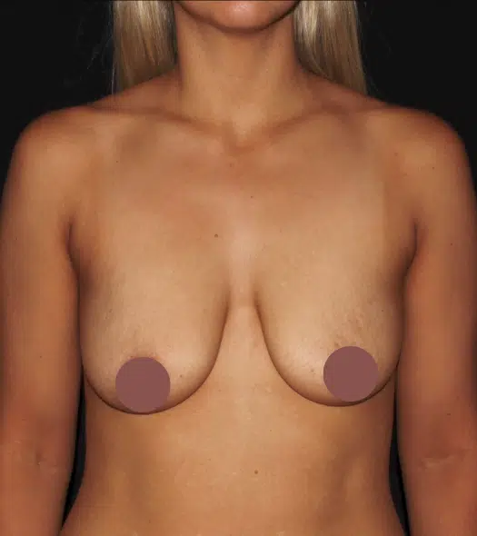 Front view before silicone gel breast augmentation showing breast volume loss and mild breast sagging prior to cosmetic surgery at a Boise cosmetic surgery practice.