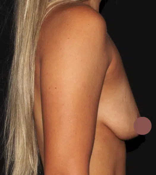 Pre-operative left side profile before silicone gel breast augmentation showing decreased breast projection and loss of fullness in Boise, Idaho.