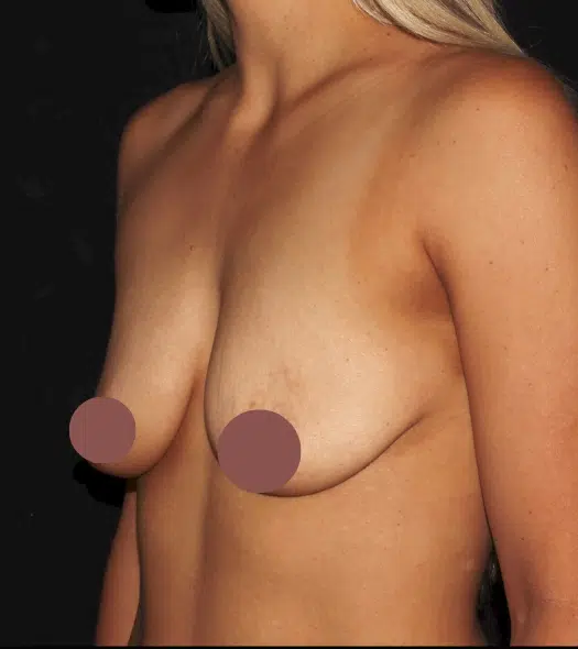 Patient before silicone gel breast augmentation, left oblique view showing breast deflation and reduced upper pole fullness before treatment in the Treasure Valley.