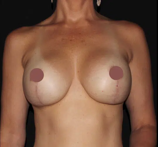 Front view after breast lift with silicone gel implants demonstrating restored breast volume and improved breast position by a Boise cosmetic surgeon serving Meridian and the Treasure Valley.