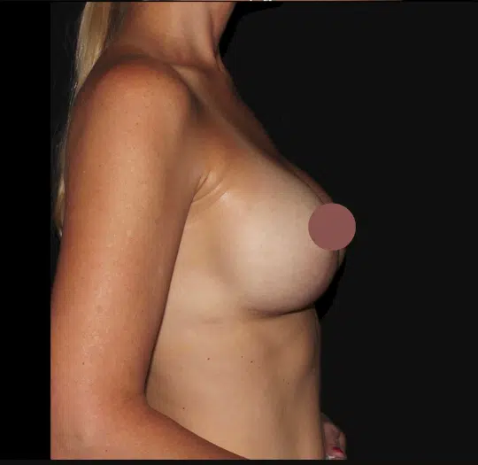 Right side profile after breast lift with silicone gel implants highlighting improved breast shape and natural-looking fullness at a Boise cosmetic surgery practice.