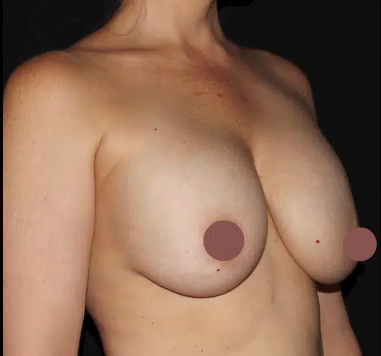 Patient before breast lift with silicone gel breast augmentation, right oblique view showing breast deflation and moderate sagging before surgery in the Treasure Valley.
