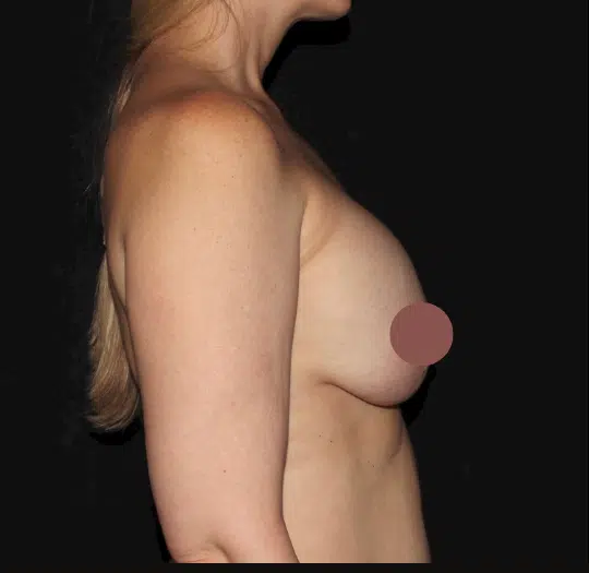 Prior to breast lift with silicone gel breast augmentation, right side profile showing breast volume loss and stretched breast tissue before cosmetic surgery in Boise.