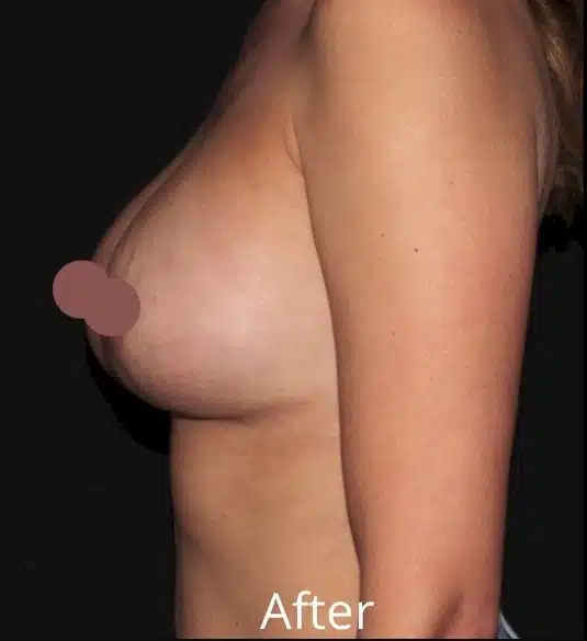 Left side profile after breast lift with implant exchange demonstrating improved breast position and enhanced projection by a Boise cosmetic surgeon serving Meridian and the Treasure Valley.